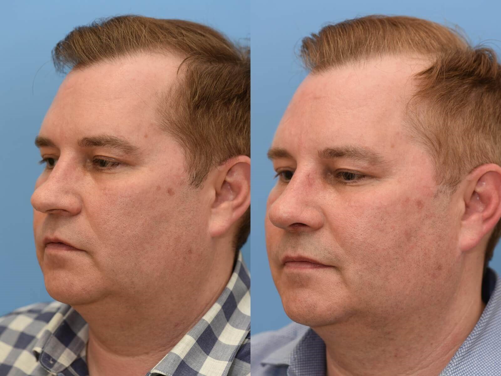 Restored Breathing! Before and After