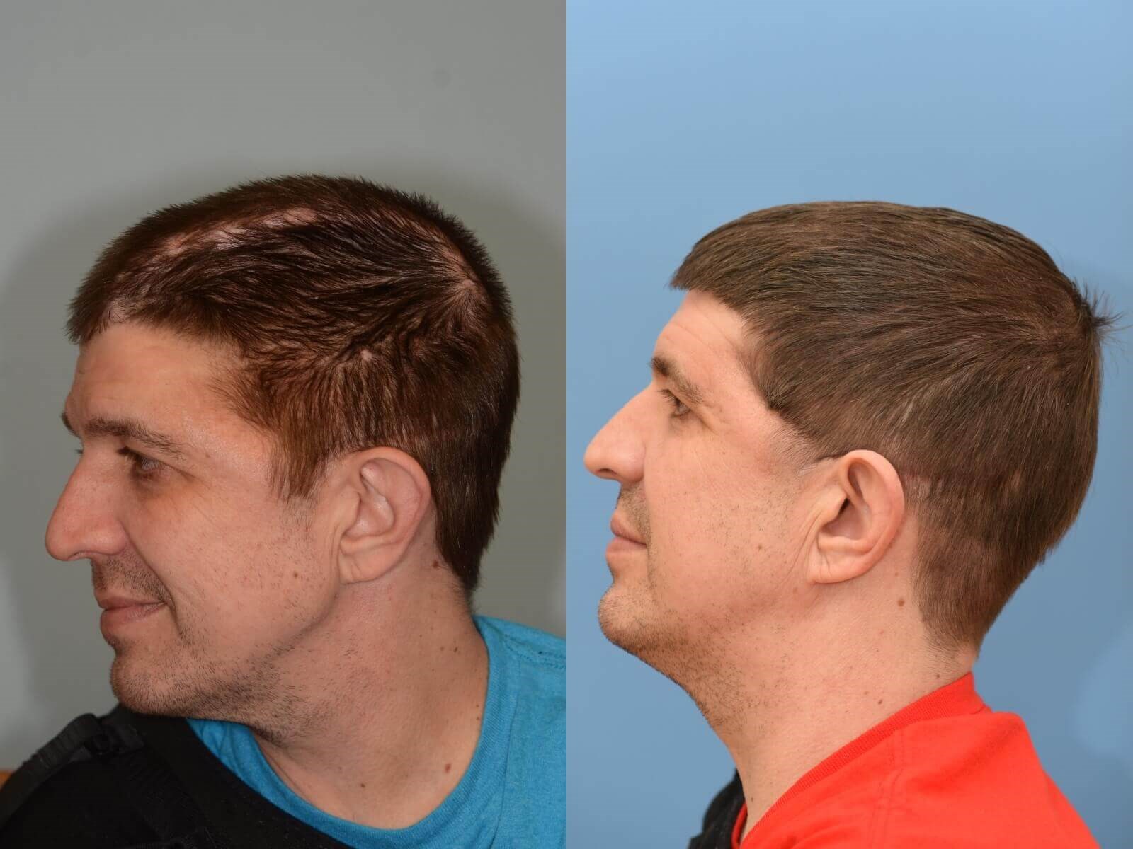 Cranioplasty Reconstruction Before and After