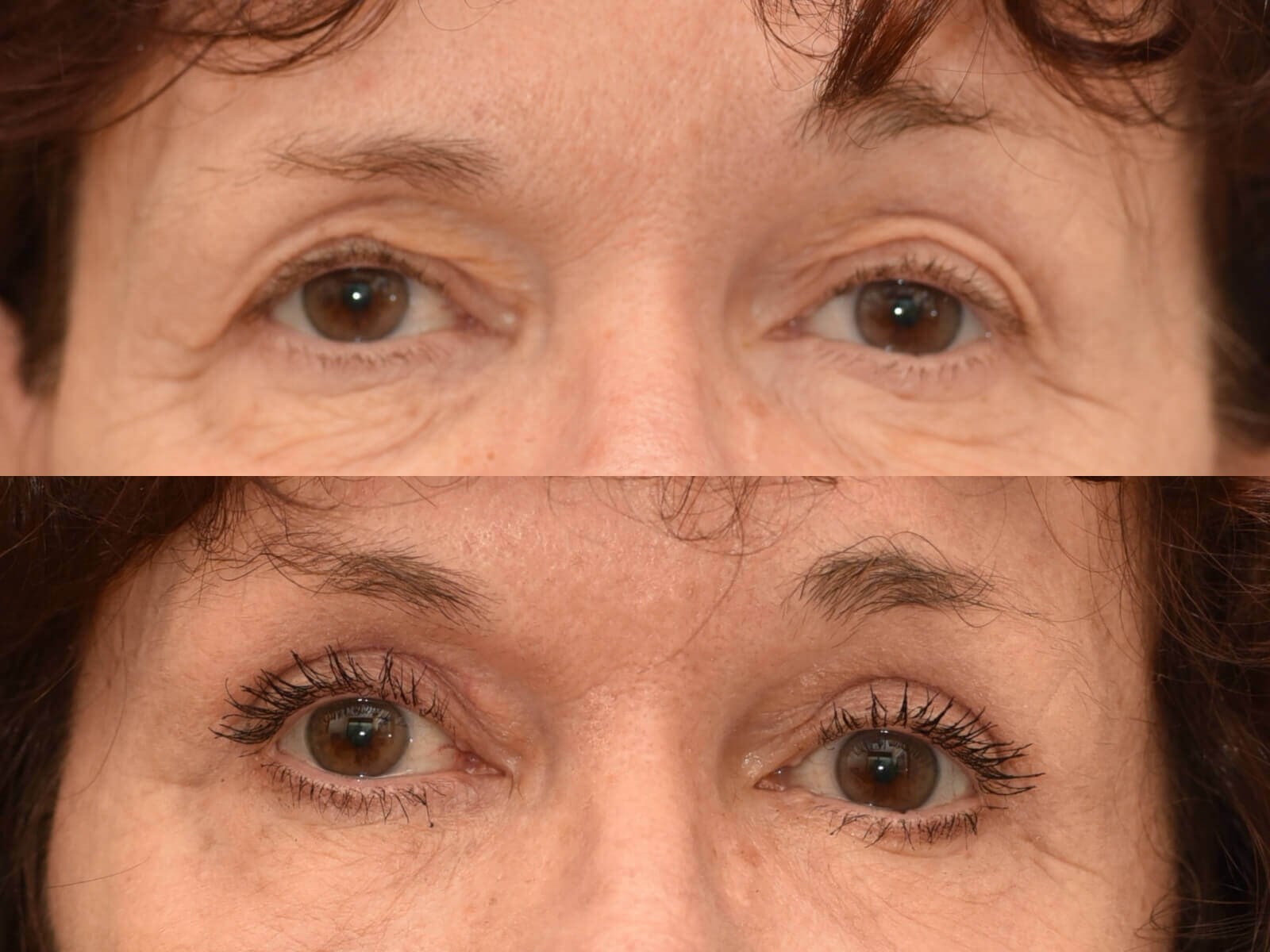 Browlift and Fat Grafting Before and After