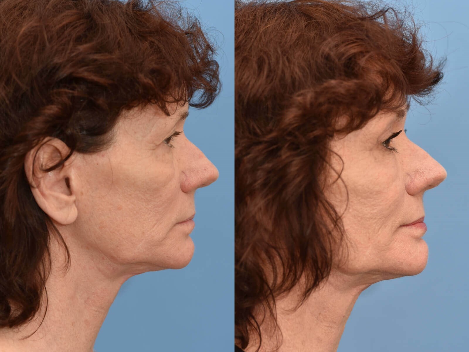 Houston, TX Browlift Before and After