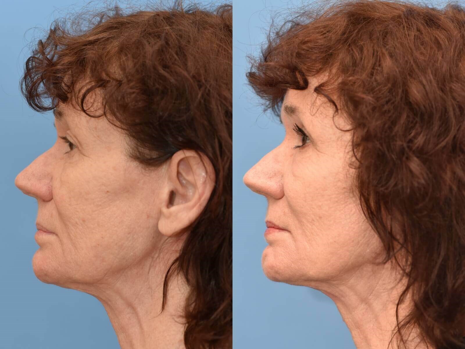 Houston, TX Browlift Before and After