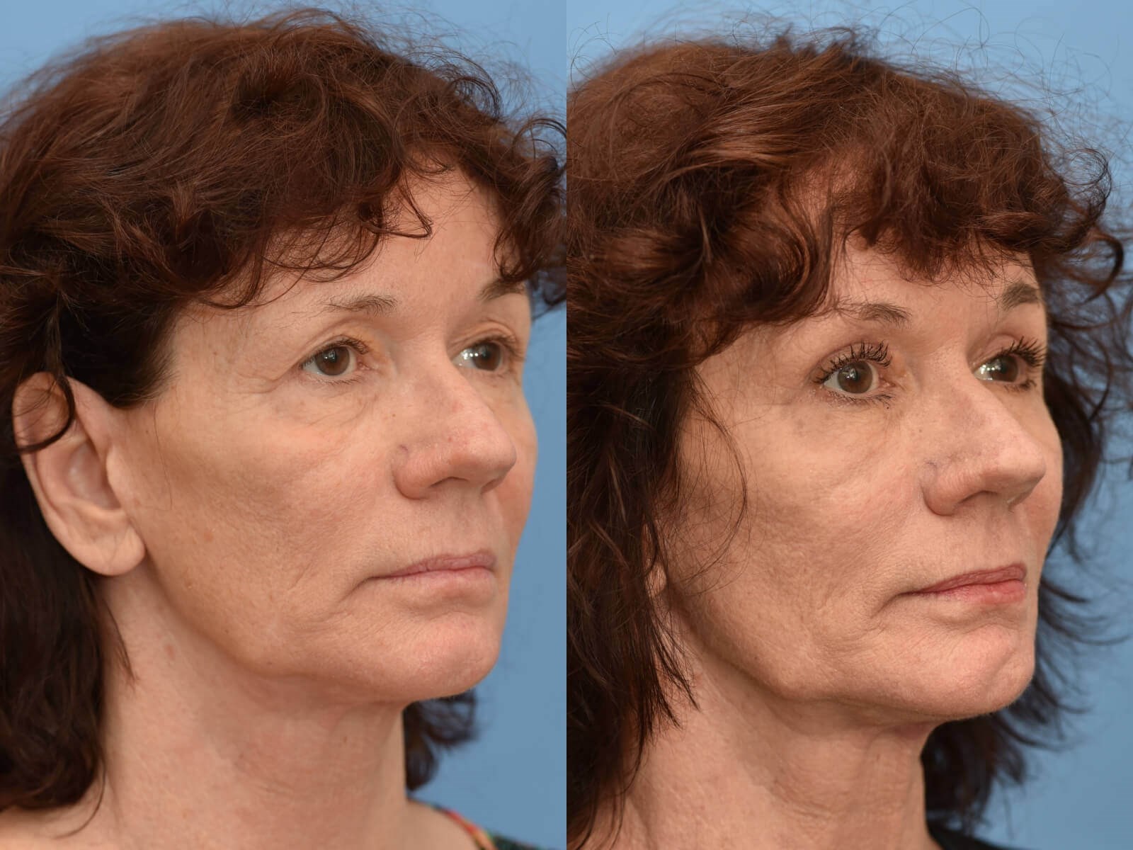 Houston fat grafting Before and After