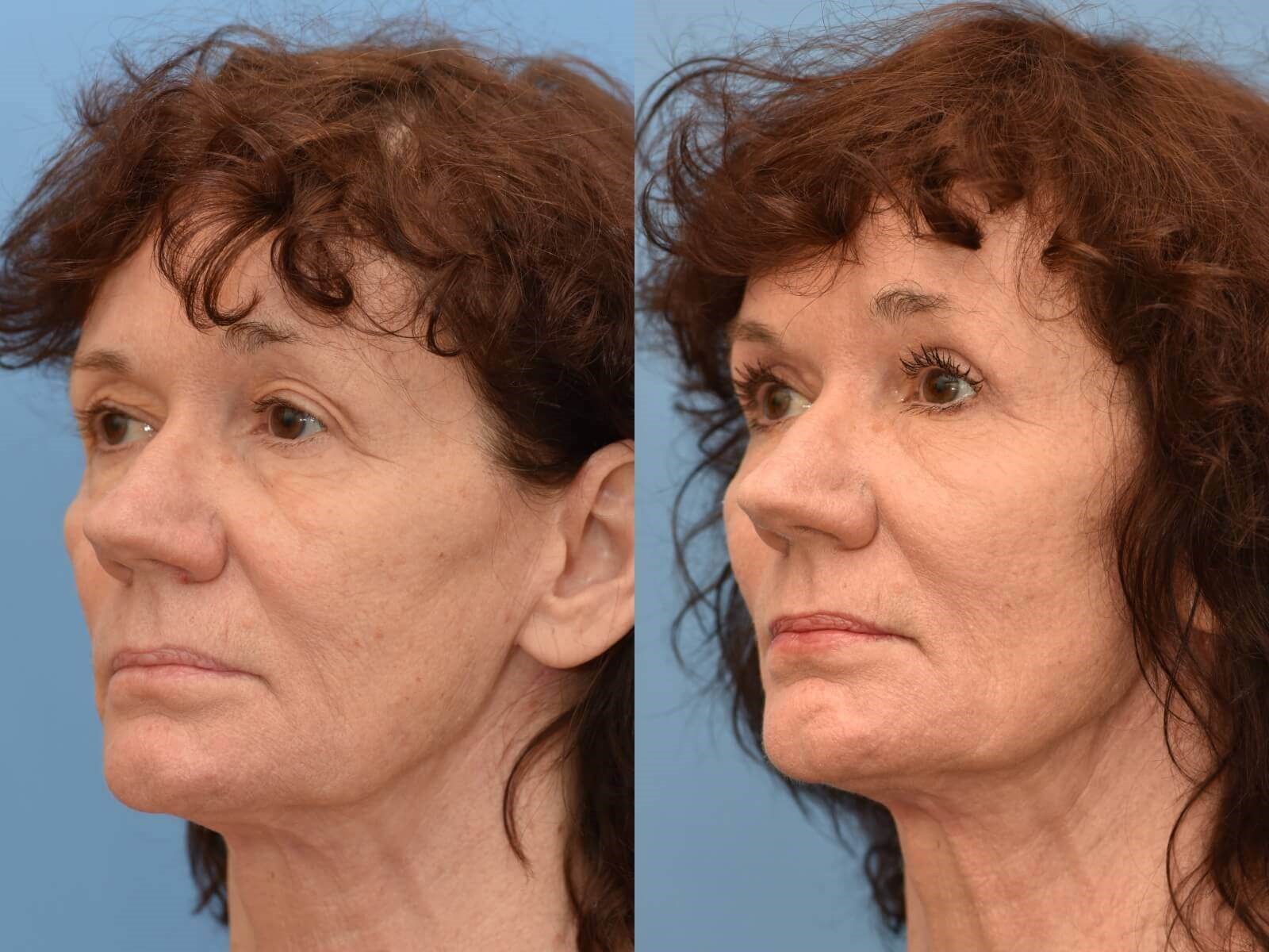 Houston fat grafting Before and After