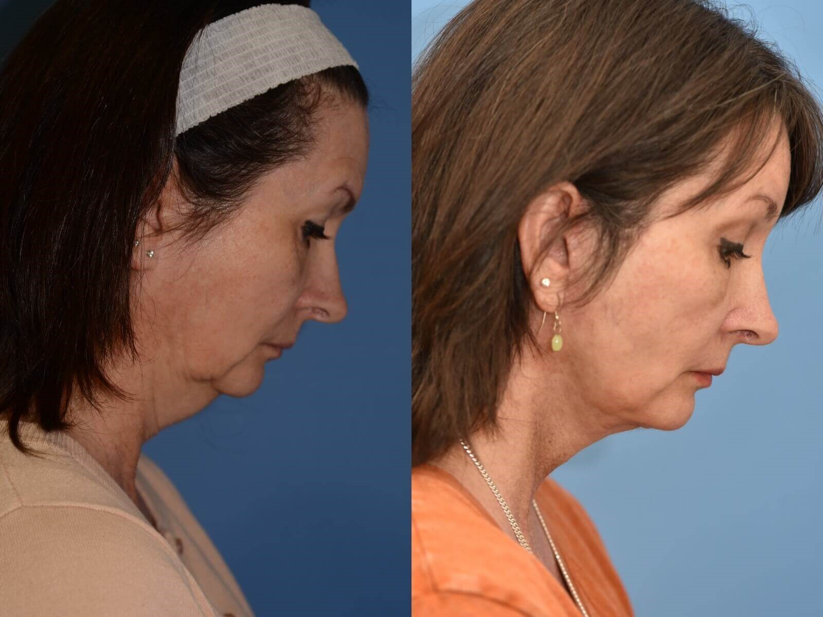 Facelift, Browlift, Necklift Before and After
