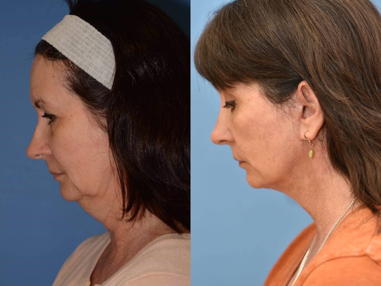 Facelift, Browlift, Necklift Before and After