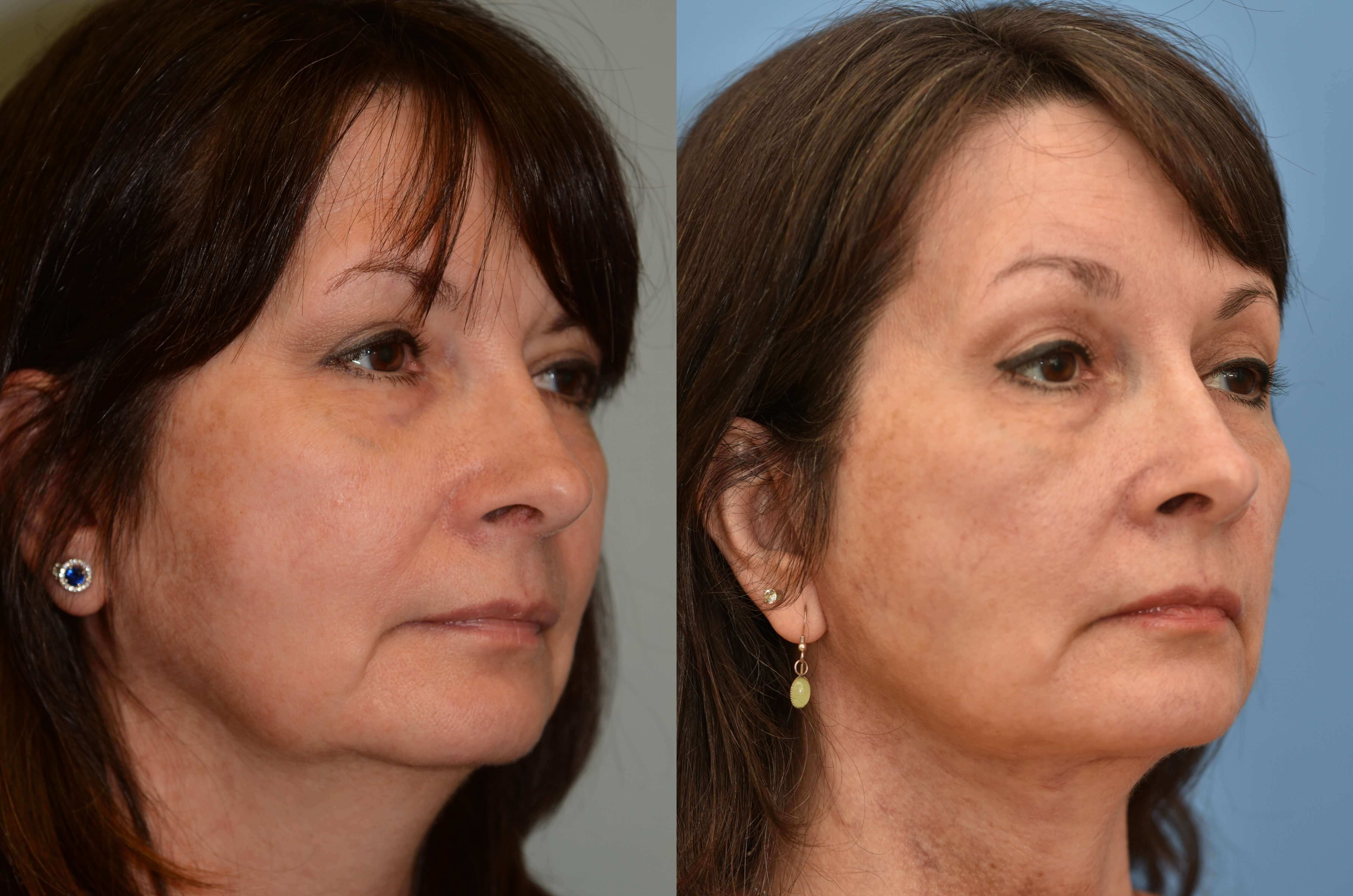 Facelift, Browlift, Necklift Before and After