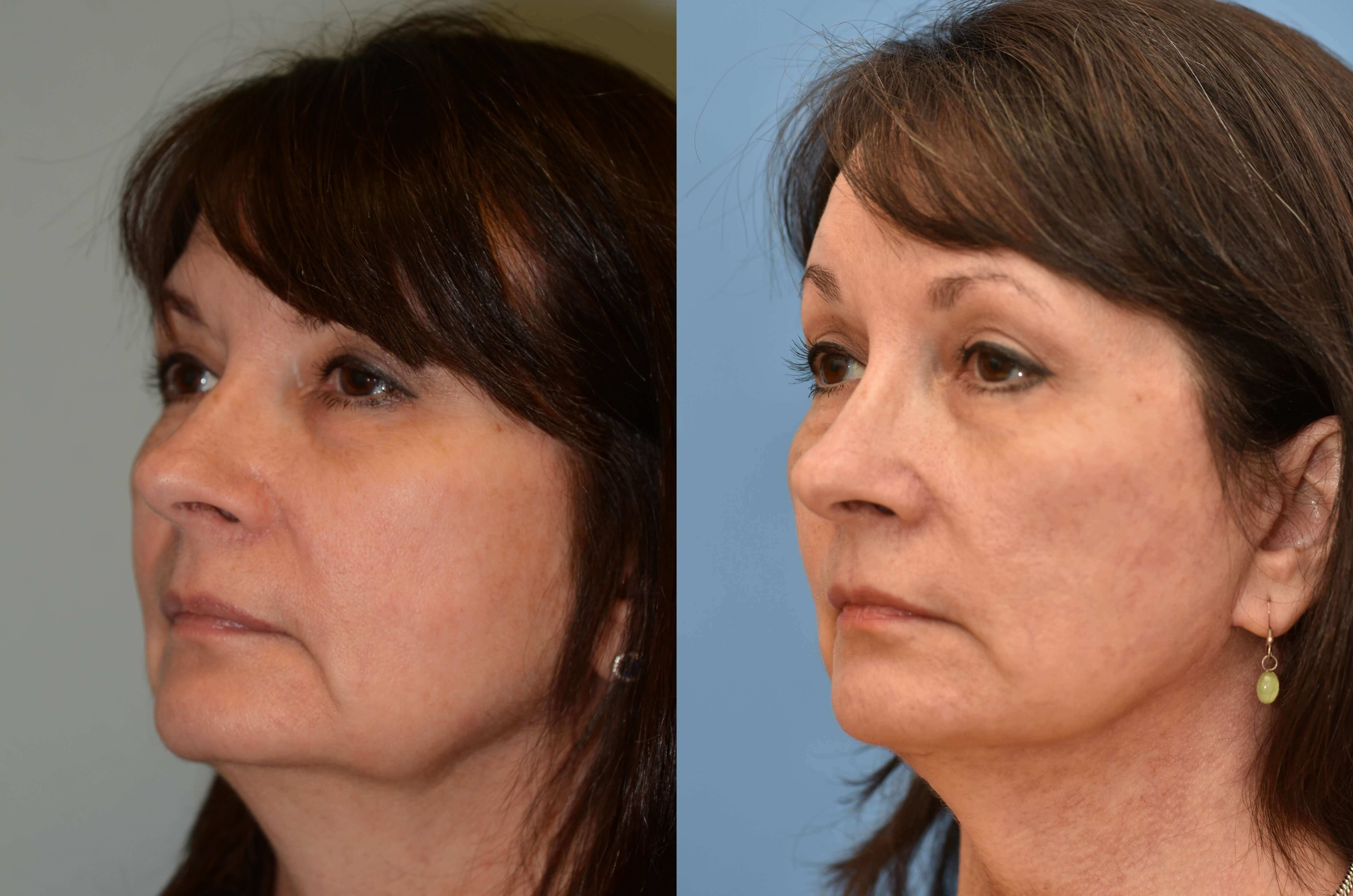 Facelift, Browlift, Necklift Before and After