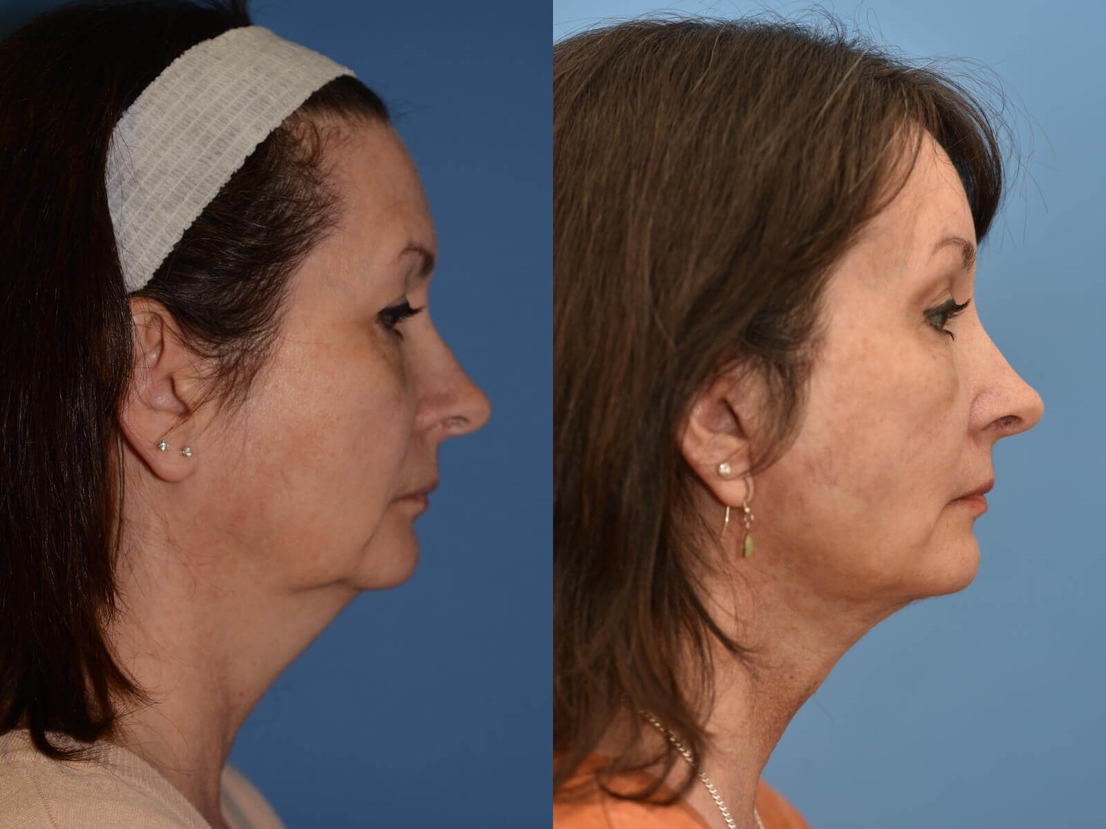 Facelift, Browlift, Necklift Before and After