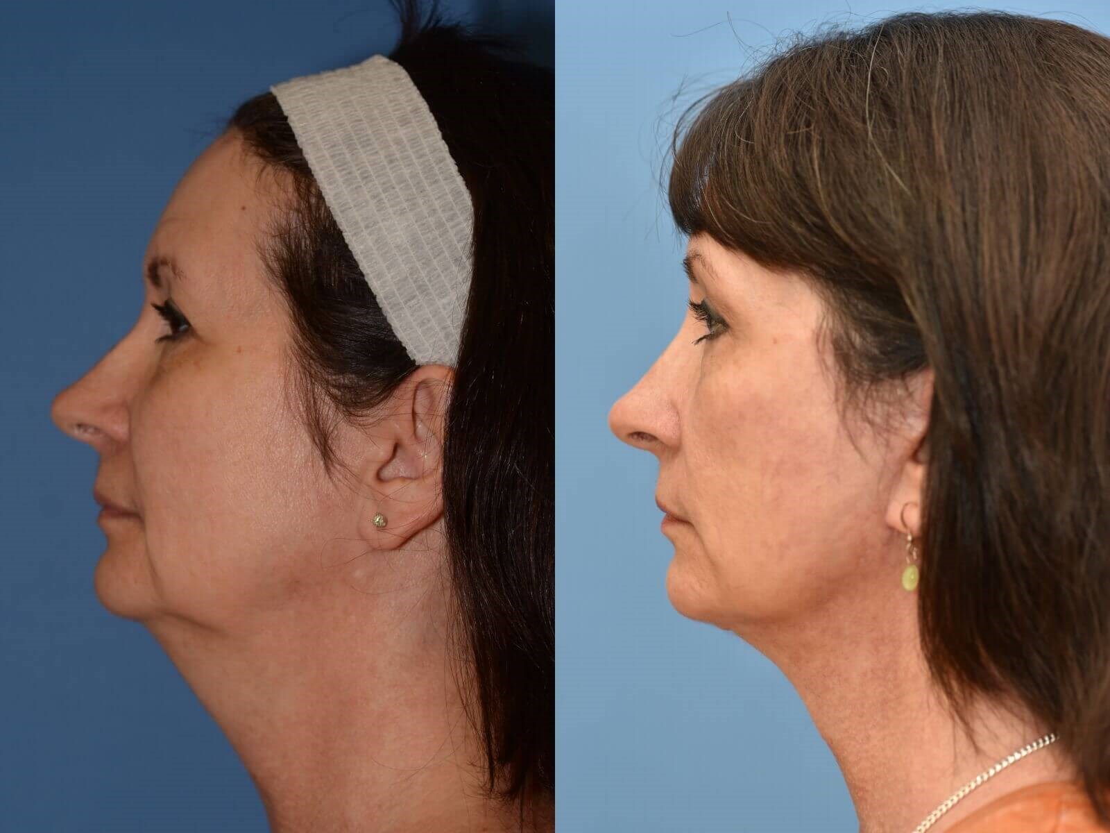 Facelift, Browlift, Necklift Before and After
