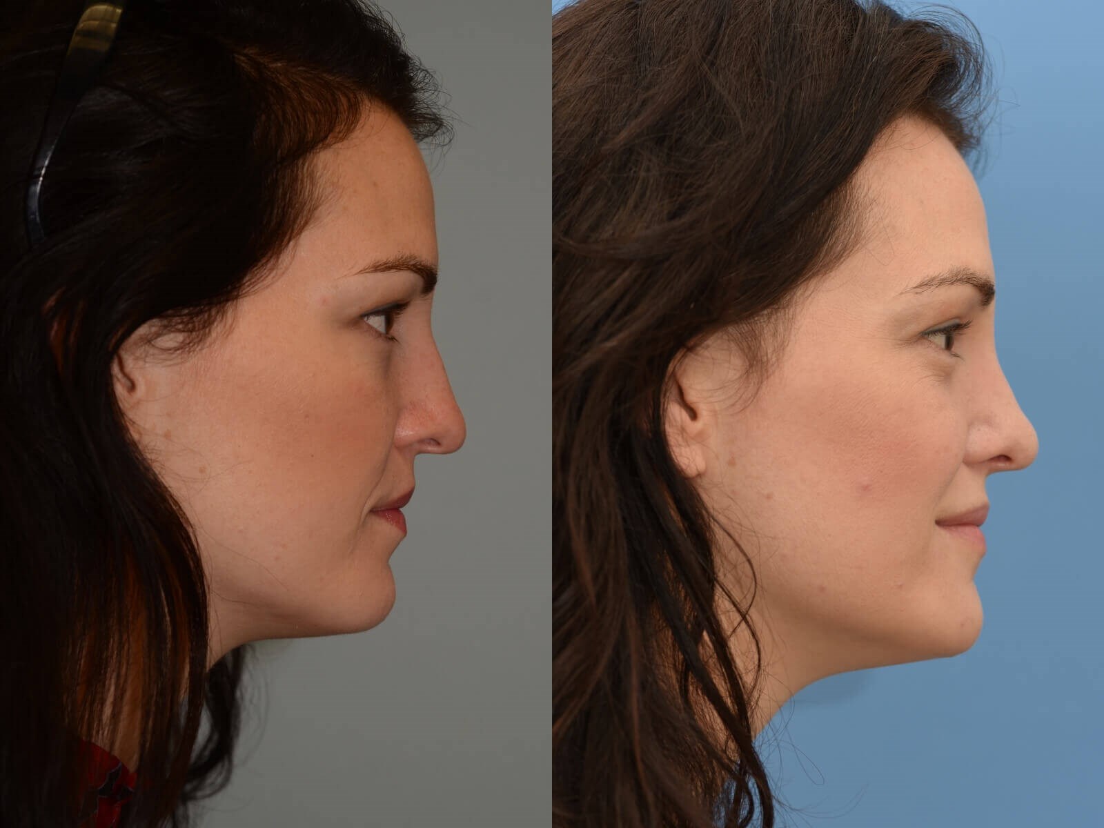 closed rhinoplasty Before and After