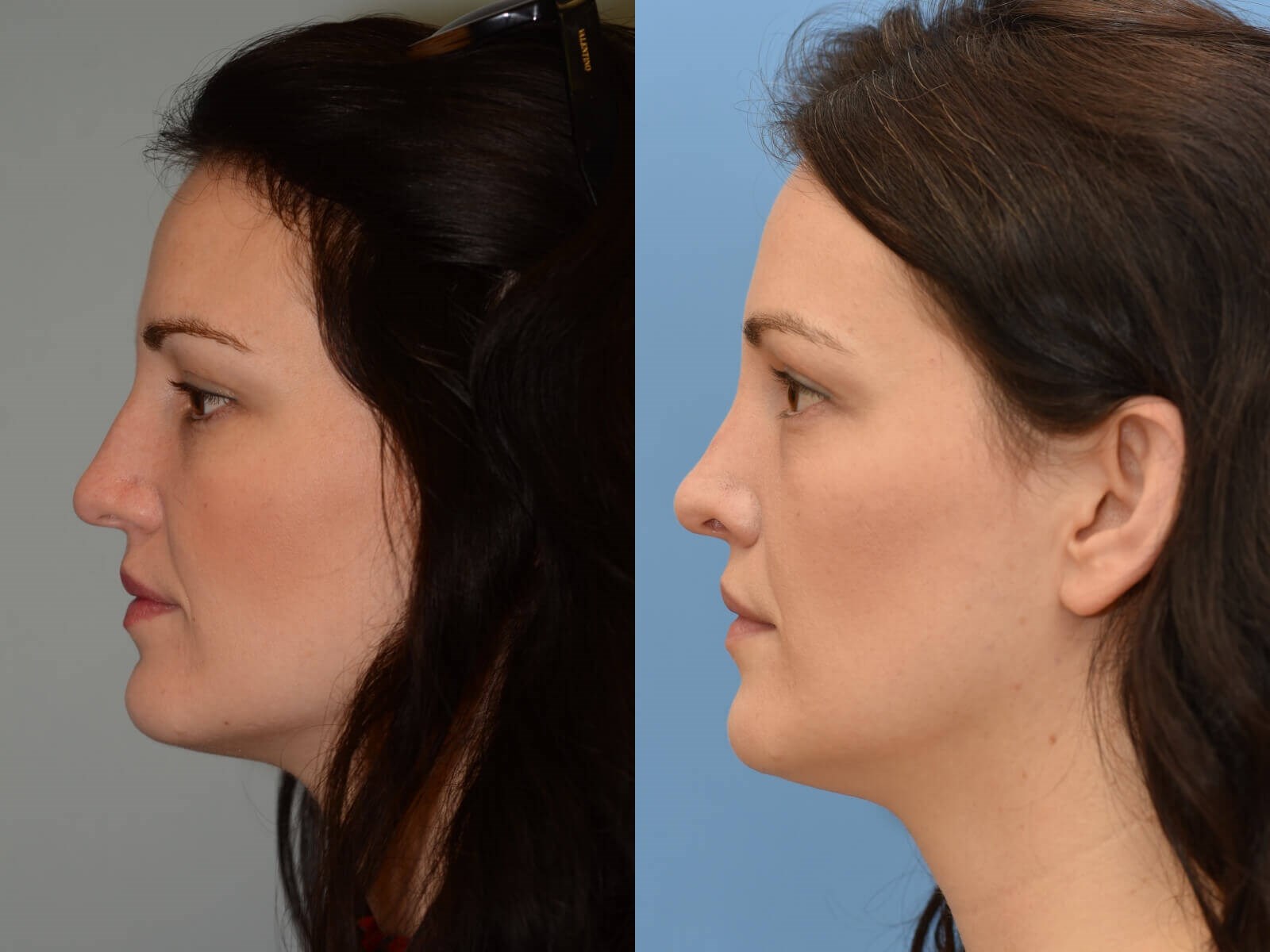 closed rhinoplasty Before and After