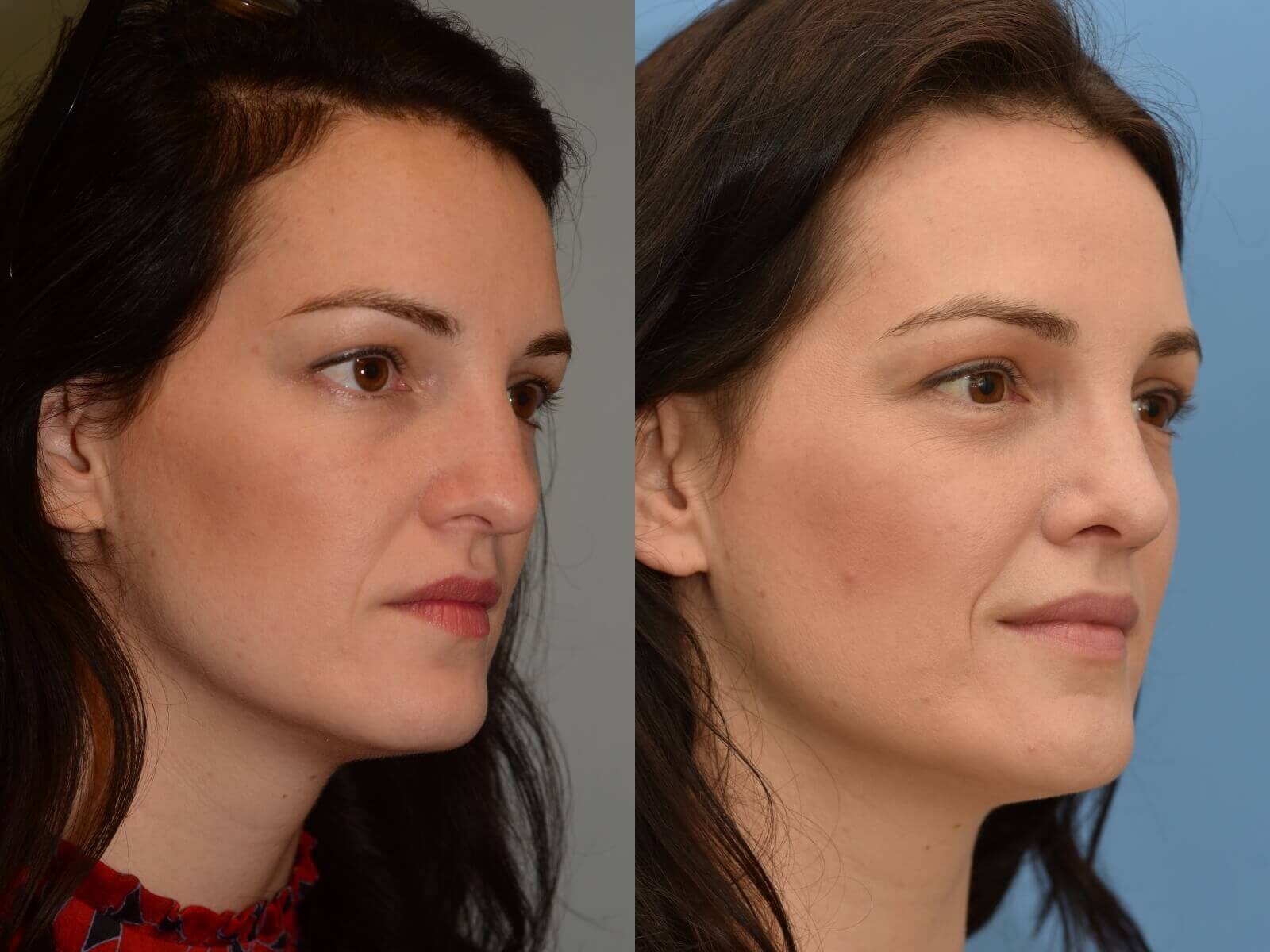 closed rhinoplasty Before and After