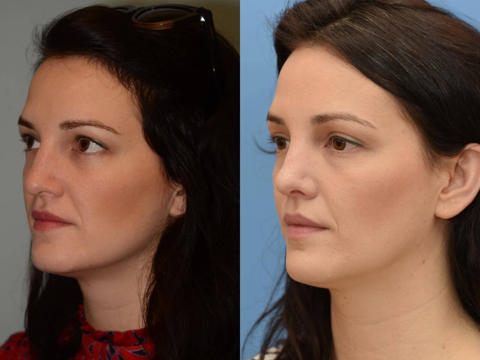 closed rhinoplasty Before and After