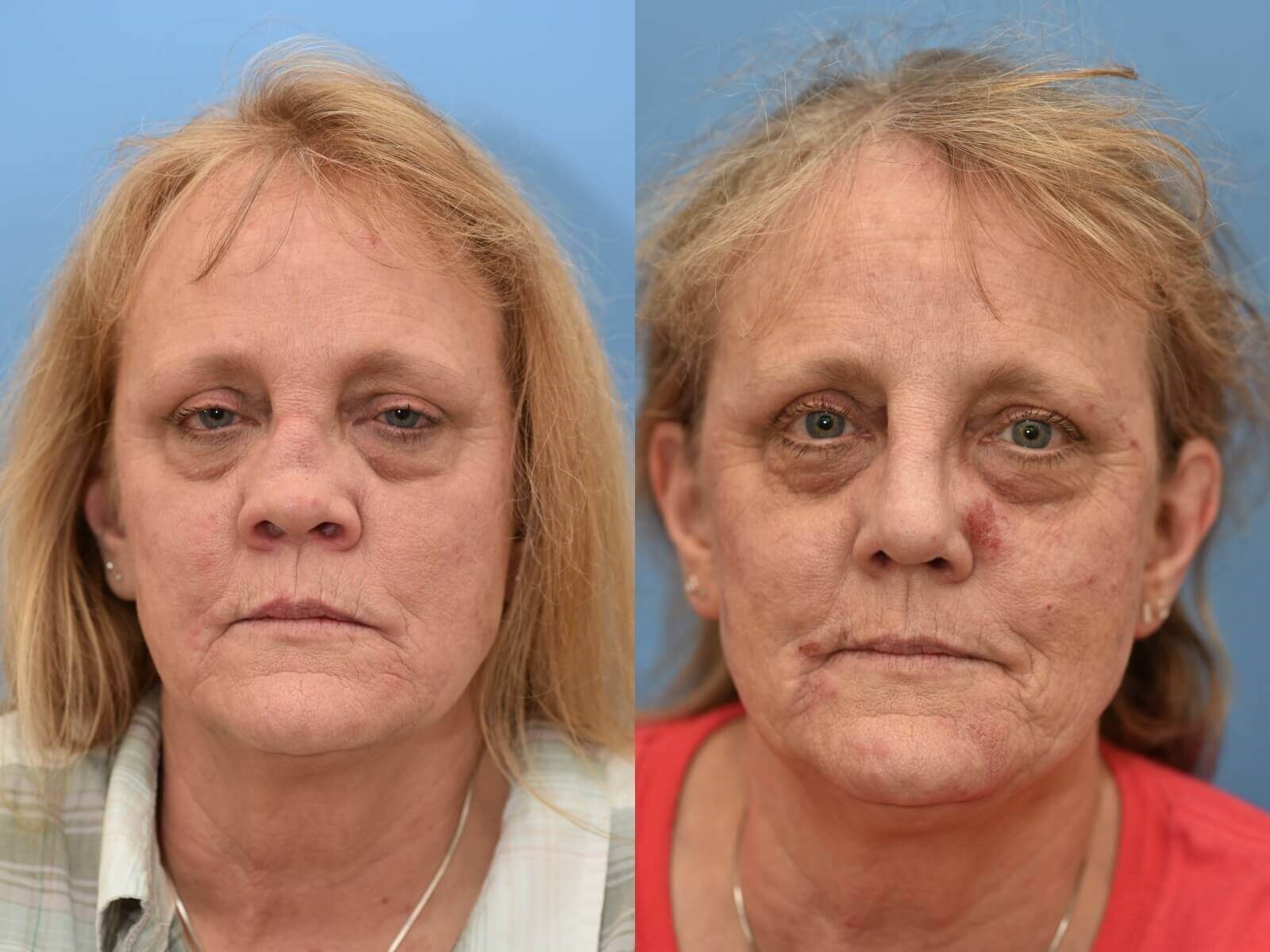 Nasal Reconstruction Before and After