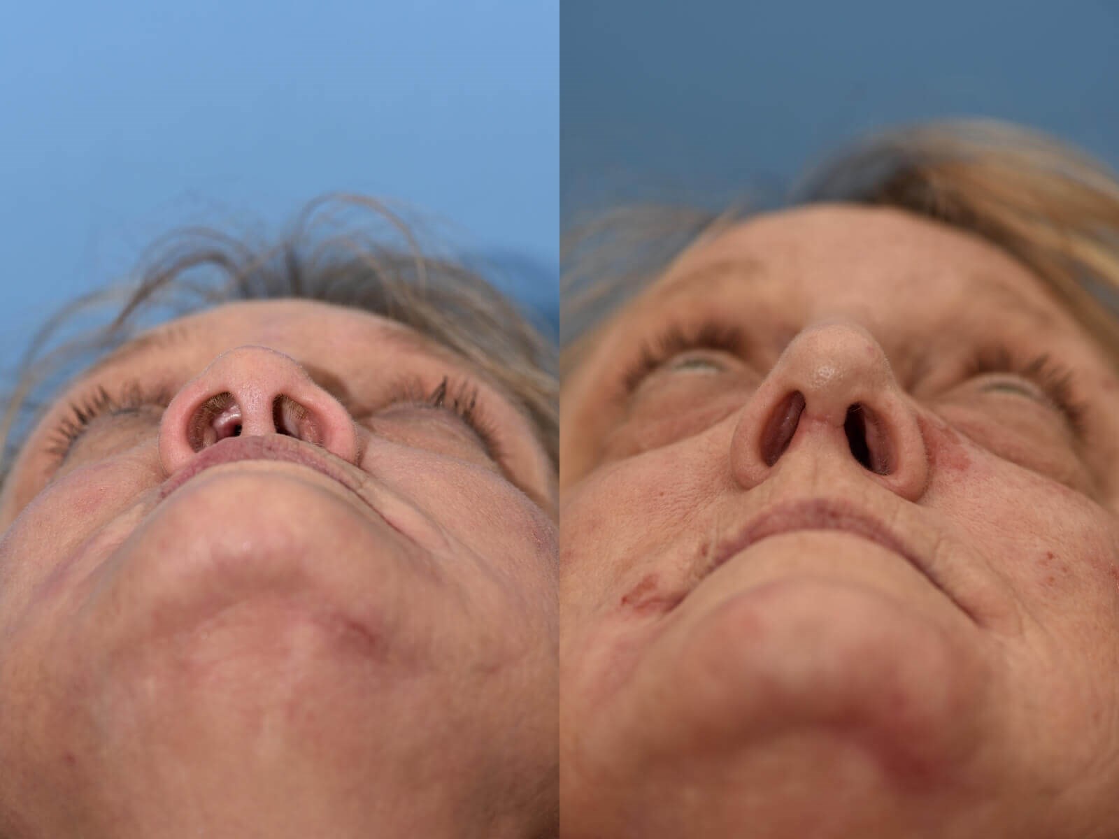 Nasal Reconstruction Before and After
