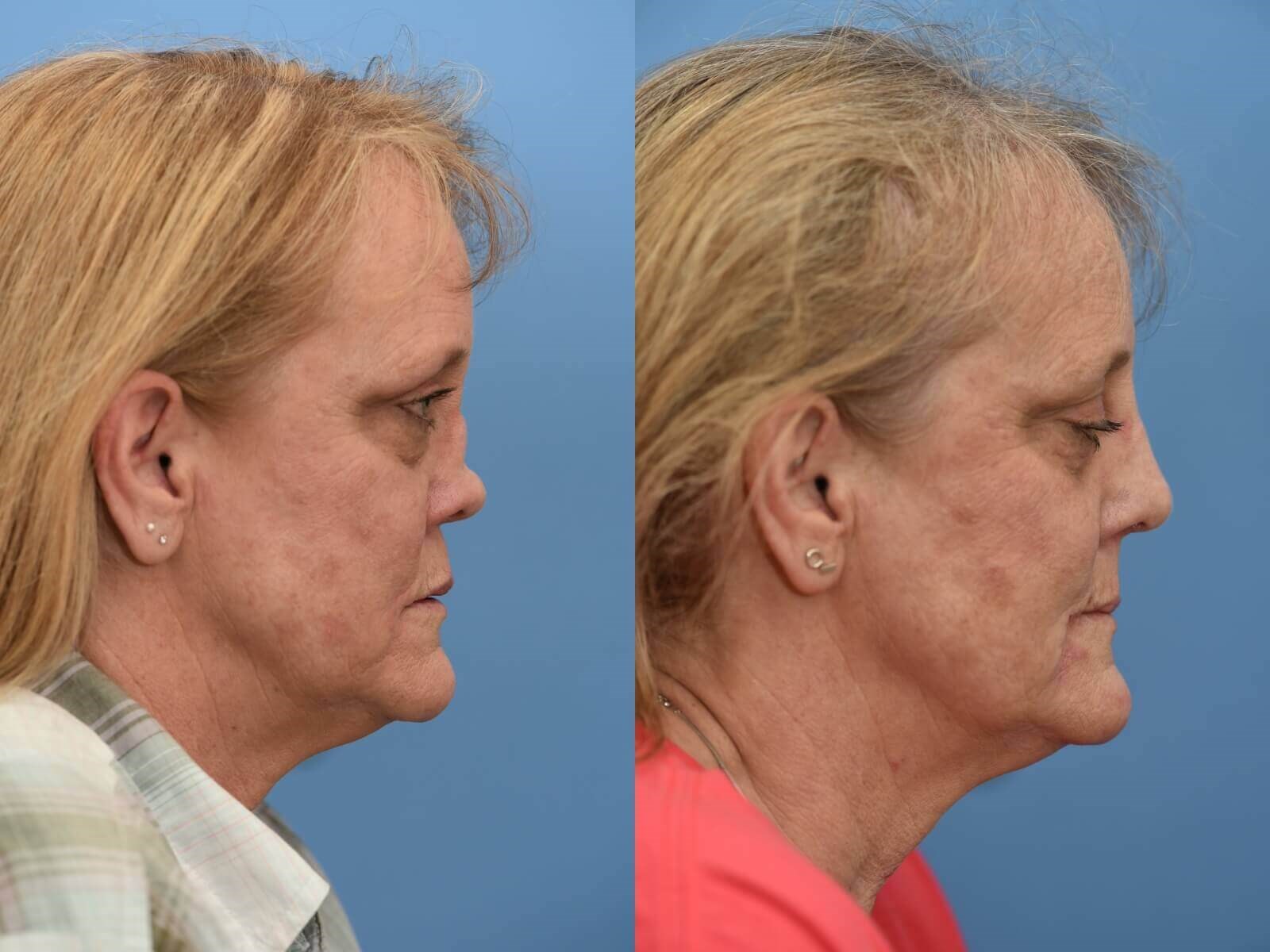 Nasal Reconstruction Before and After