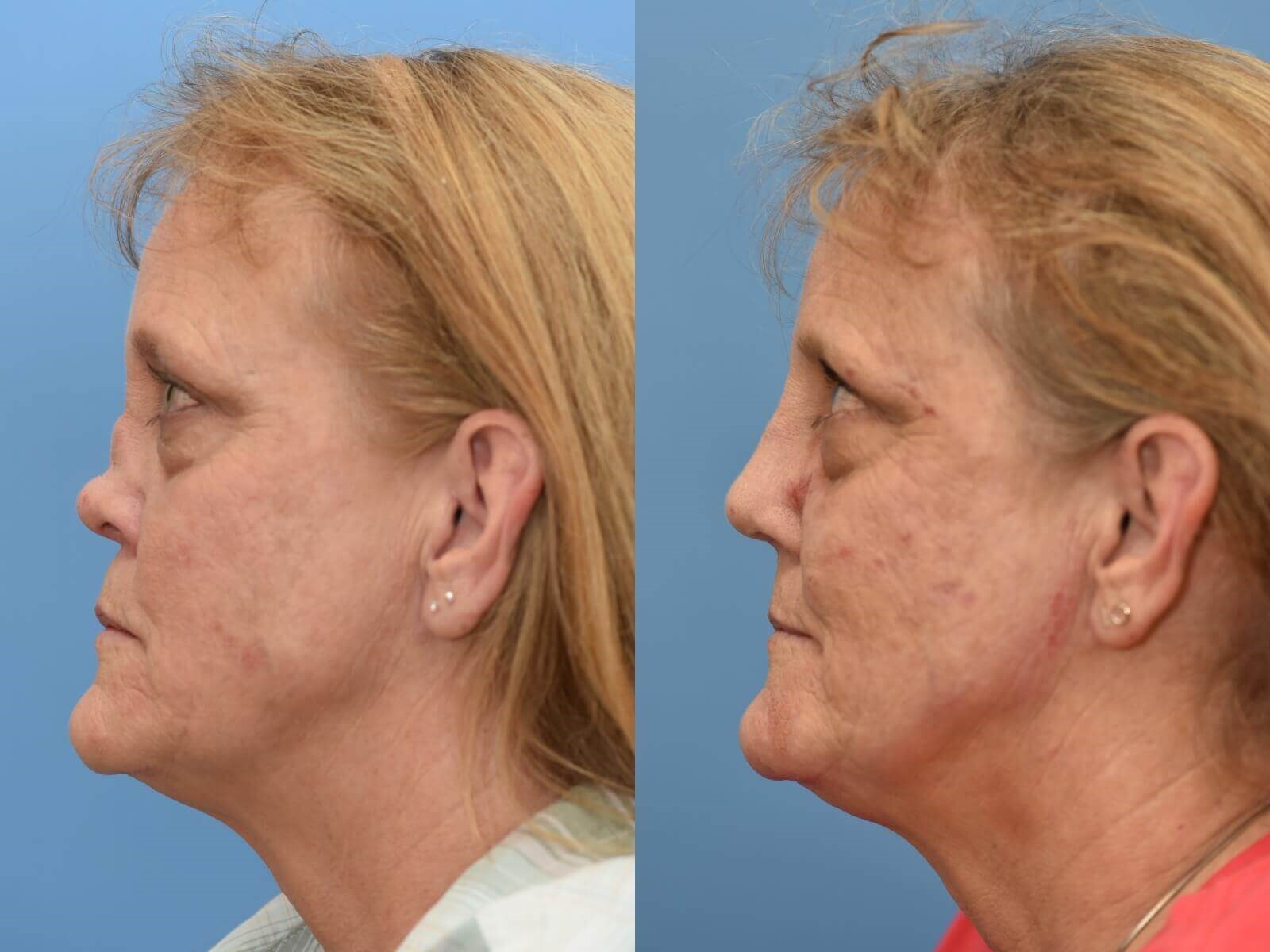 Nasal Reconstruction Before and After