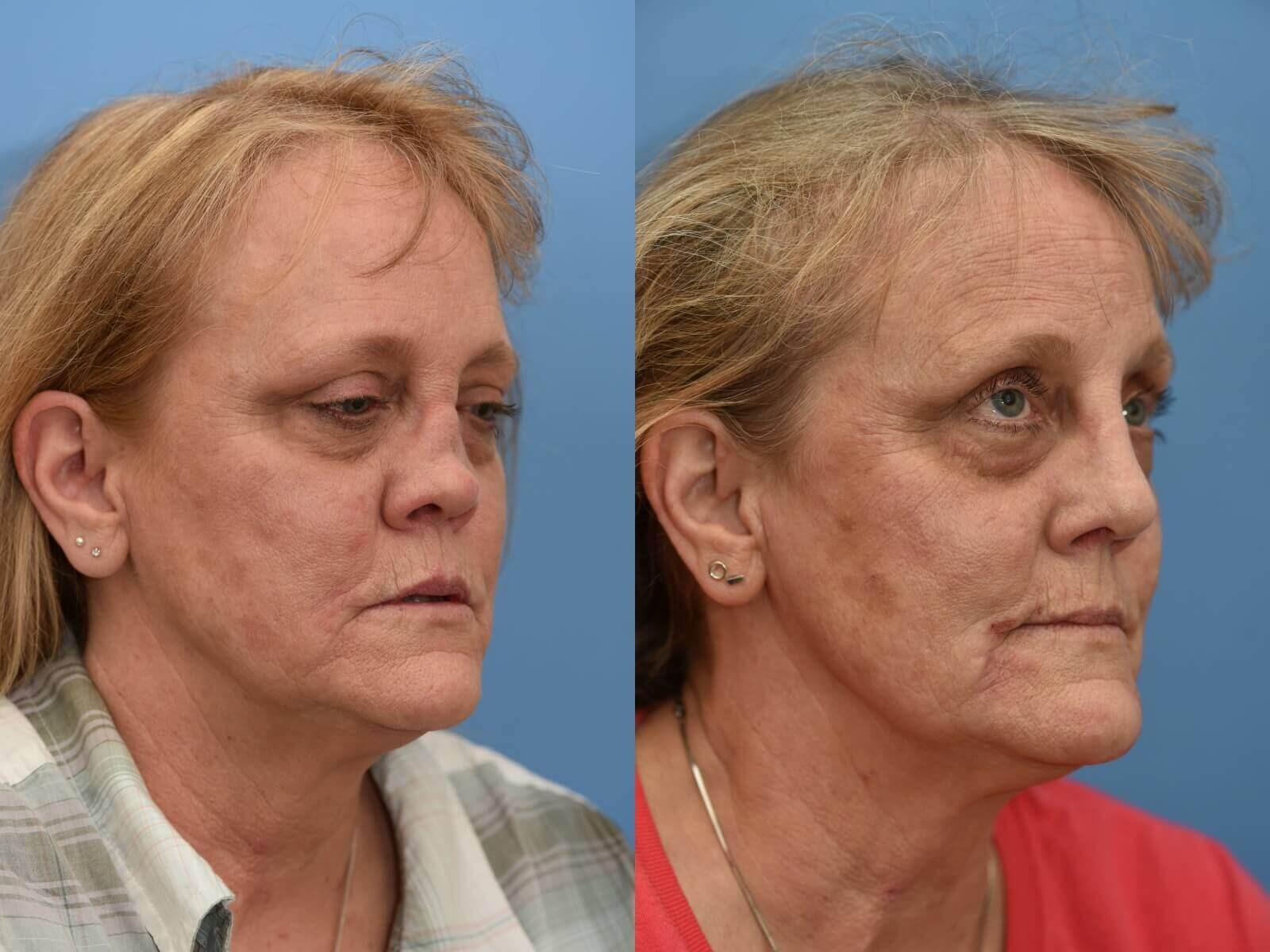 Nasal Reconstruction Before and After