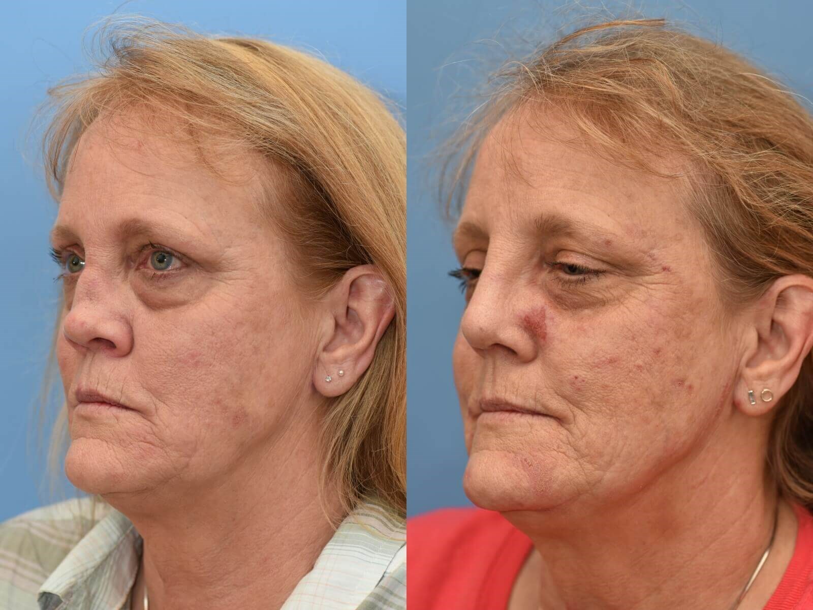 Nasal Reconstruction Before and After