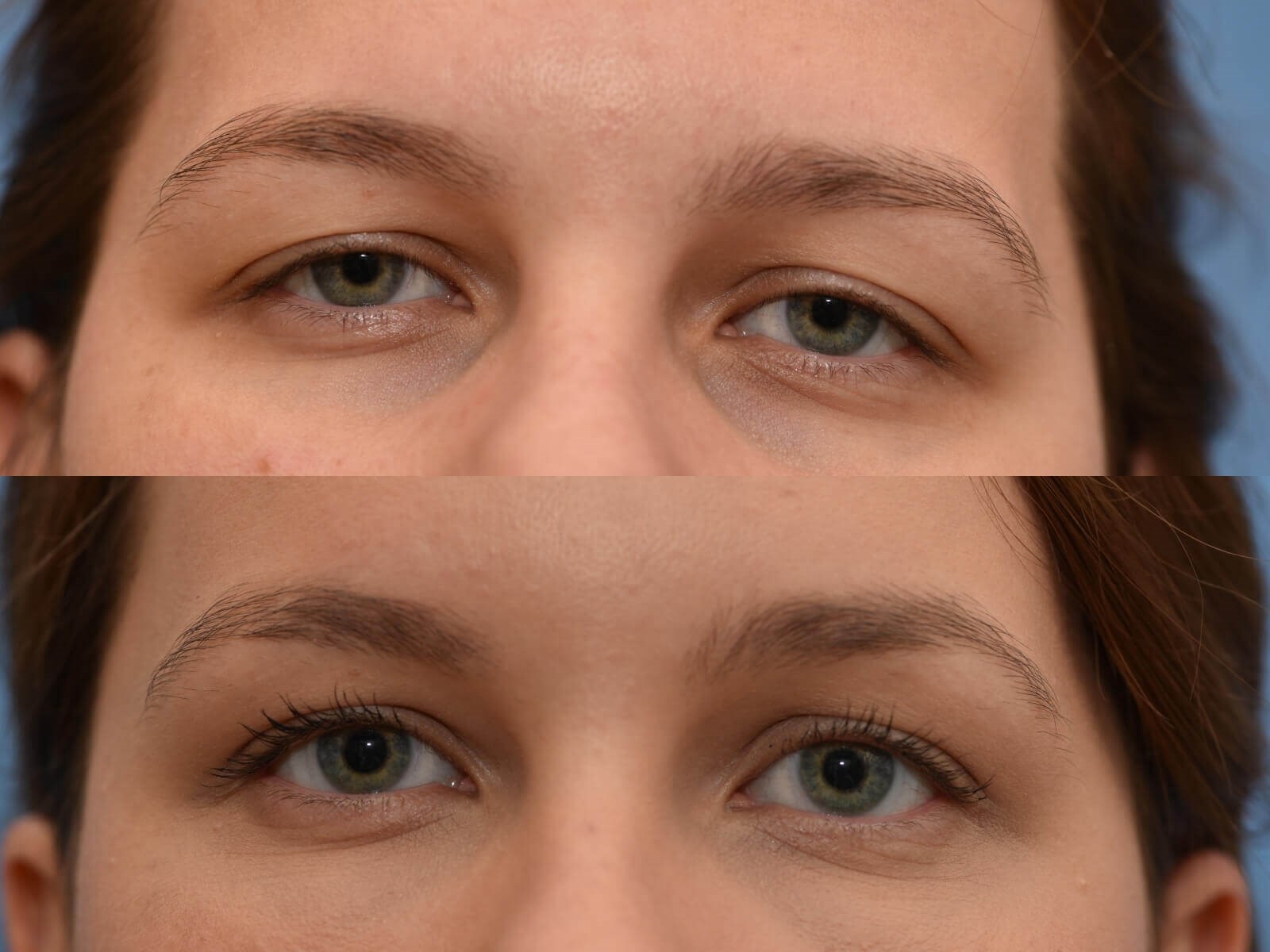Browlift, Chin Liposuction Before and After