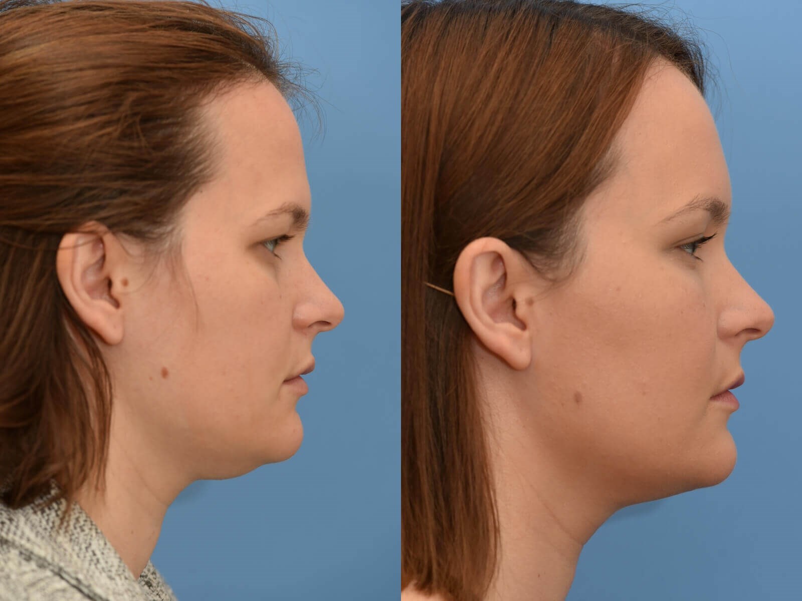 Browlift, Chin Liposuction Before and After