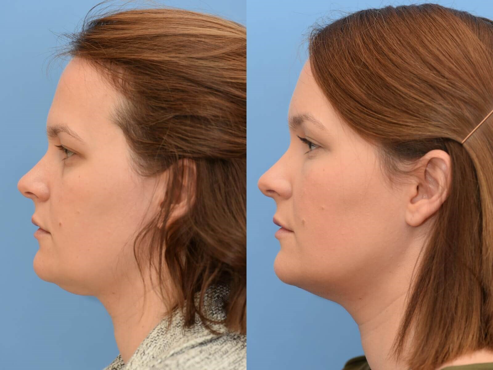 Browlift, Chin Liposuction Before and After