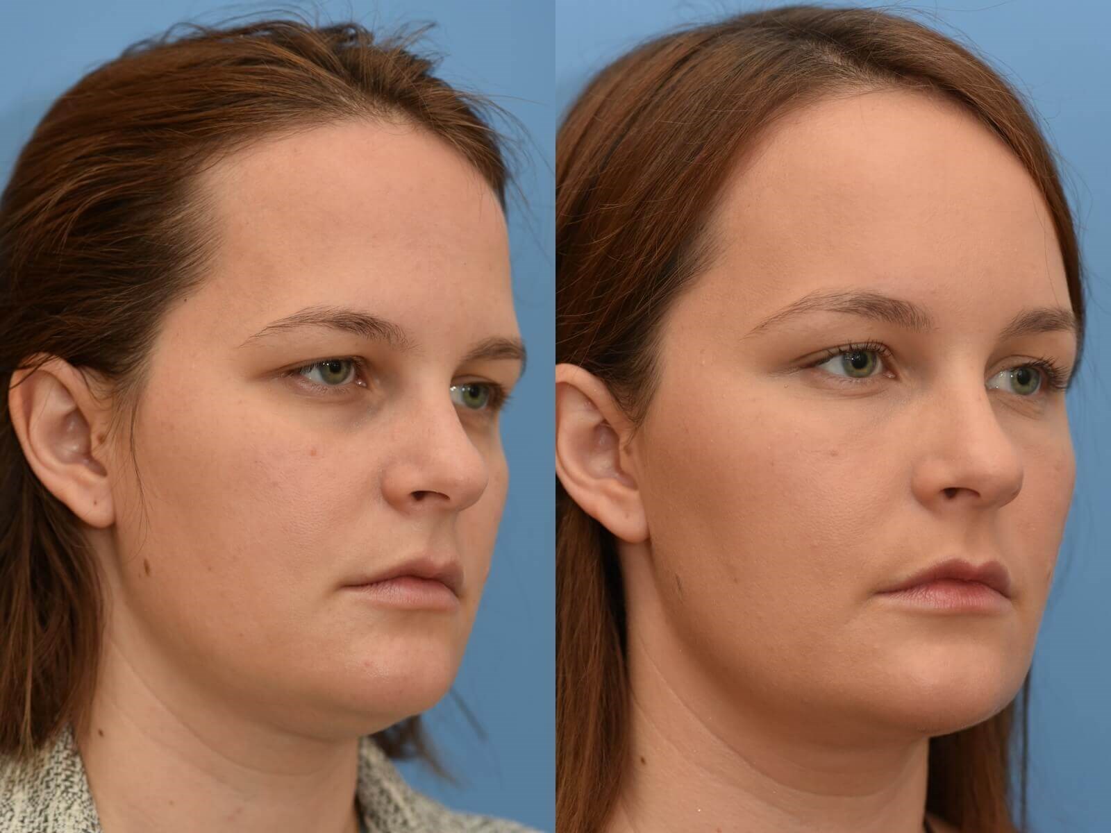 Browlift, Chin Liposuction Before and Afer