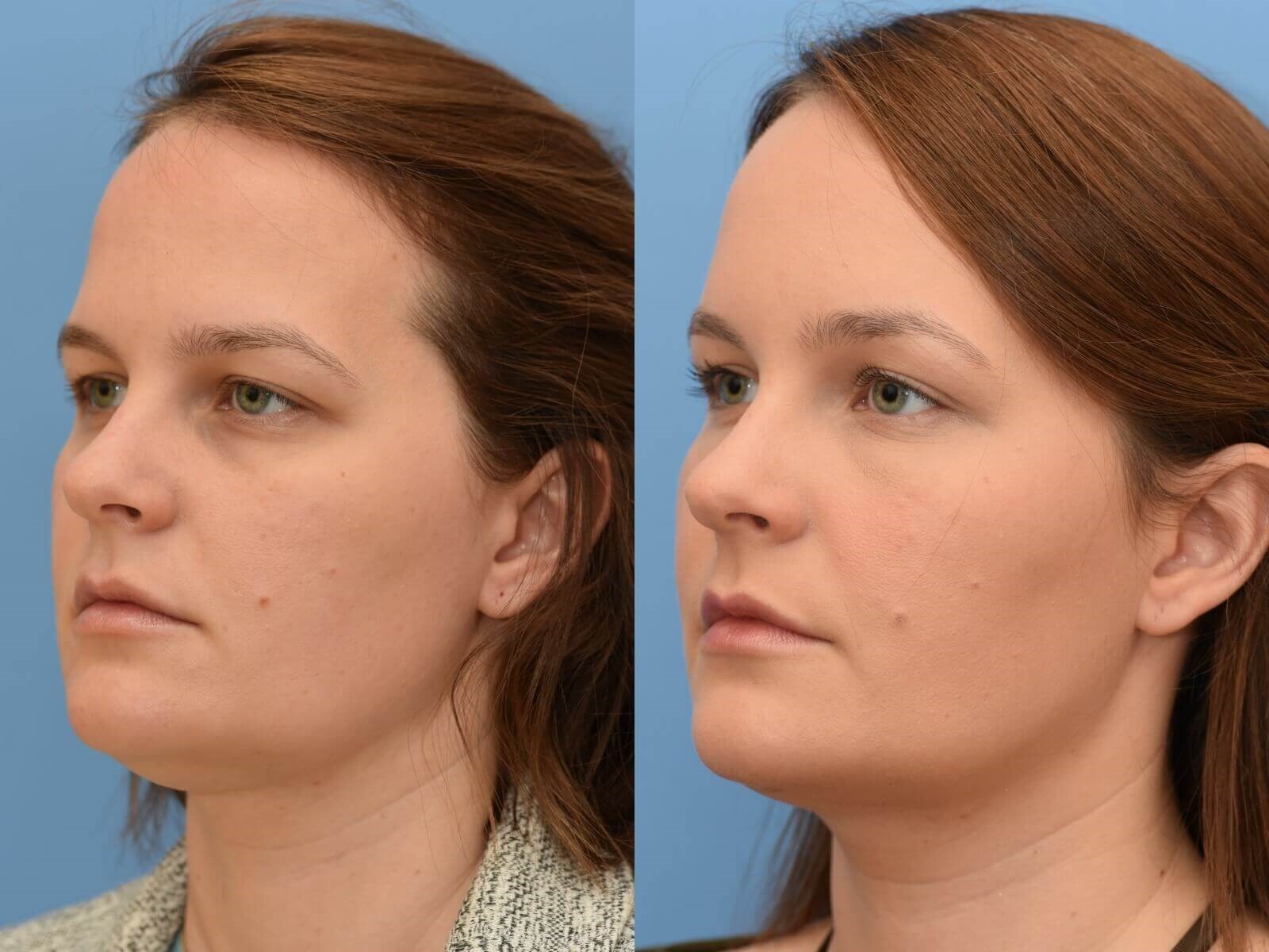 Browlift, Chin Liposuction Before and After