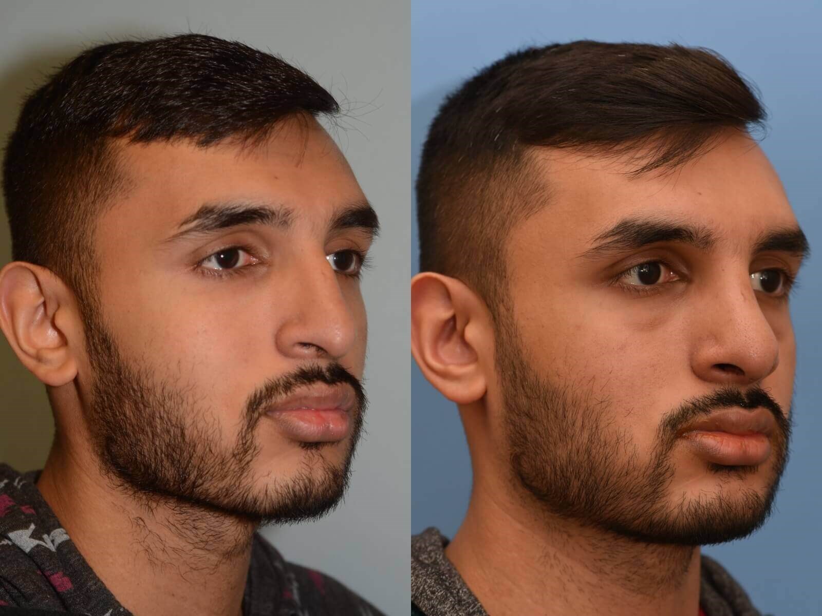 Revision Rhinoplasty Before and After