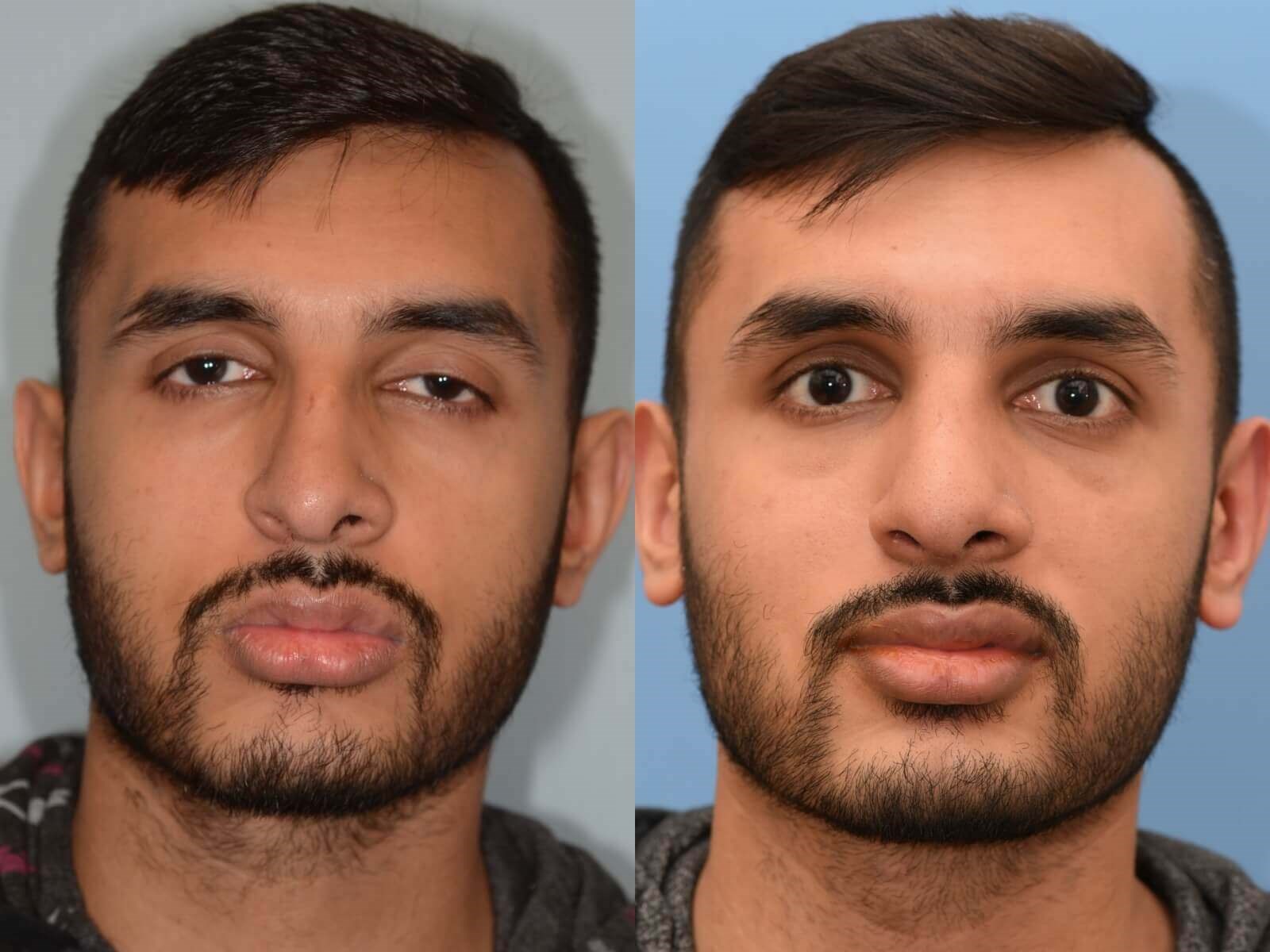 Revision Rhinoplasty Before and After