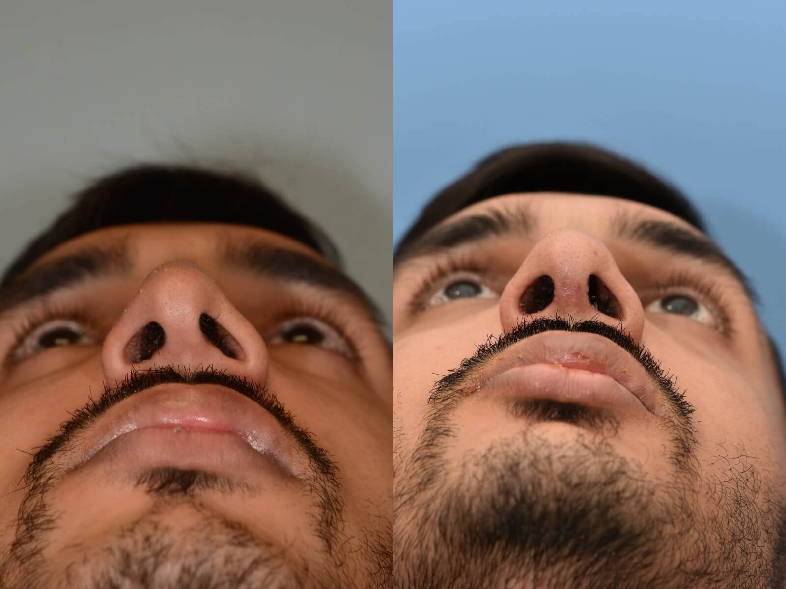 Revision Rhinoplasty Before and After