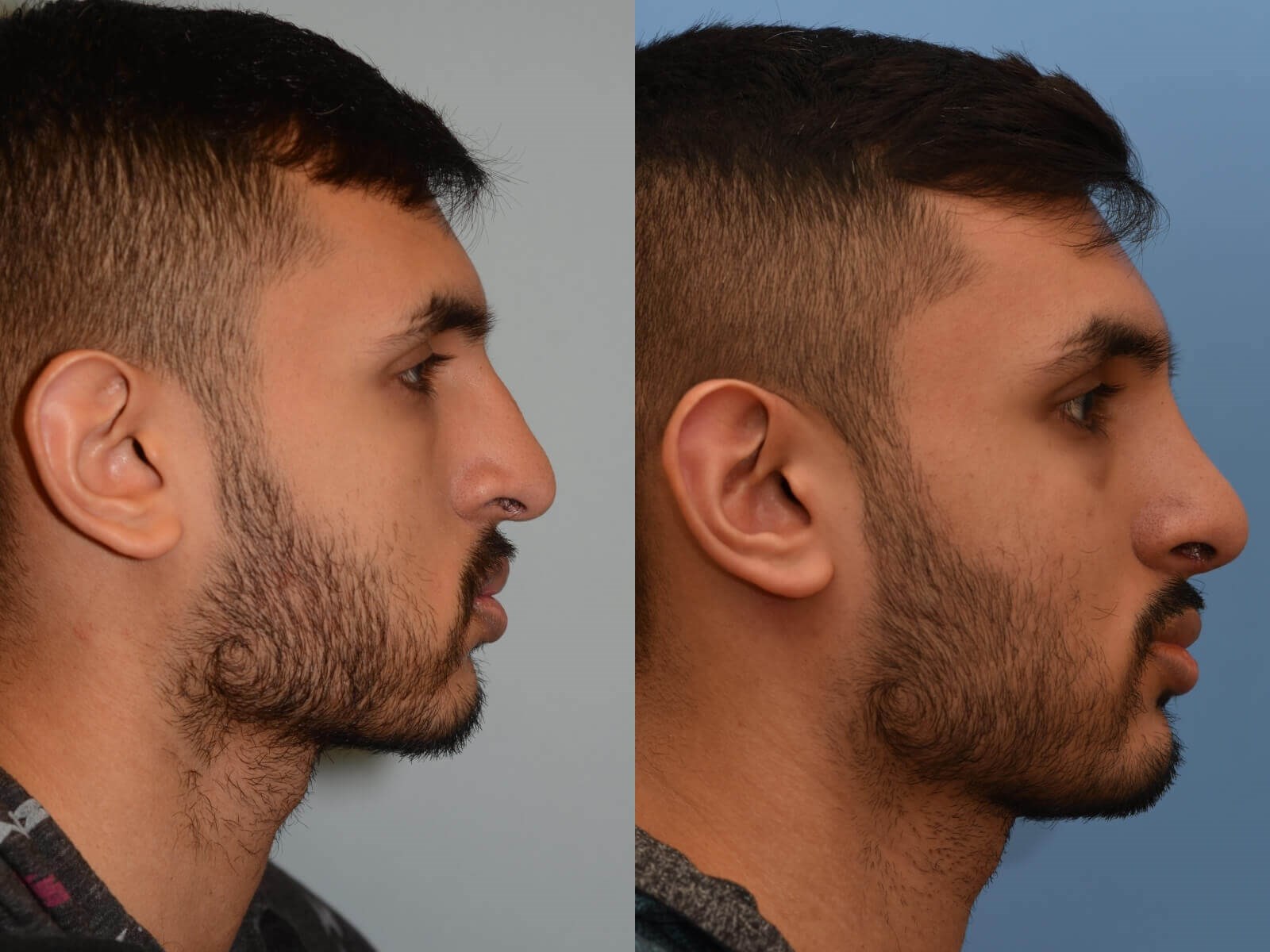 Revision Rhinoplasty Before and After