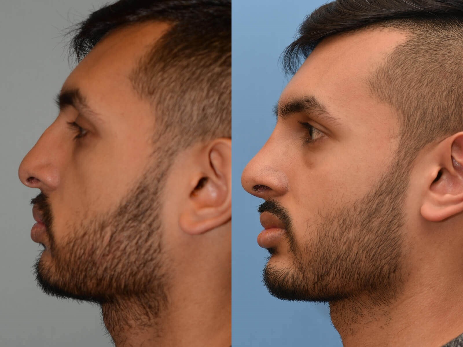 Revision Rhinoplasty Before and After