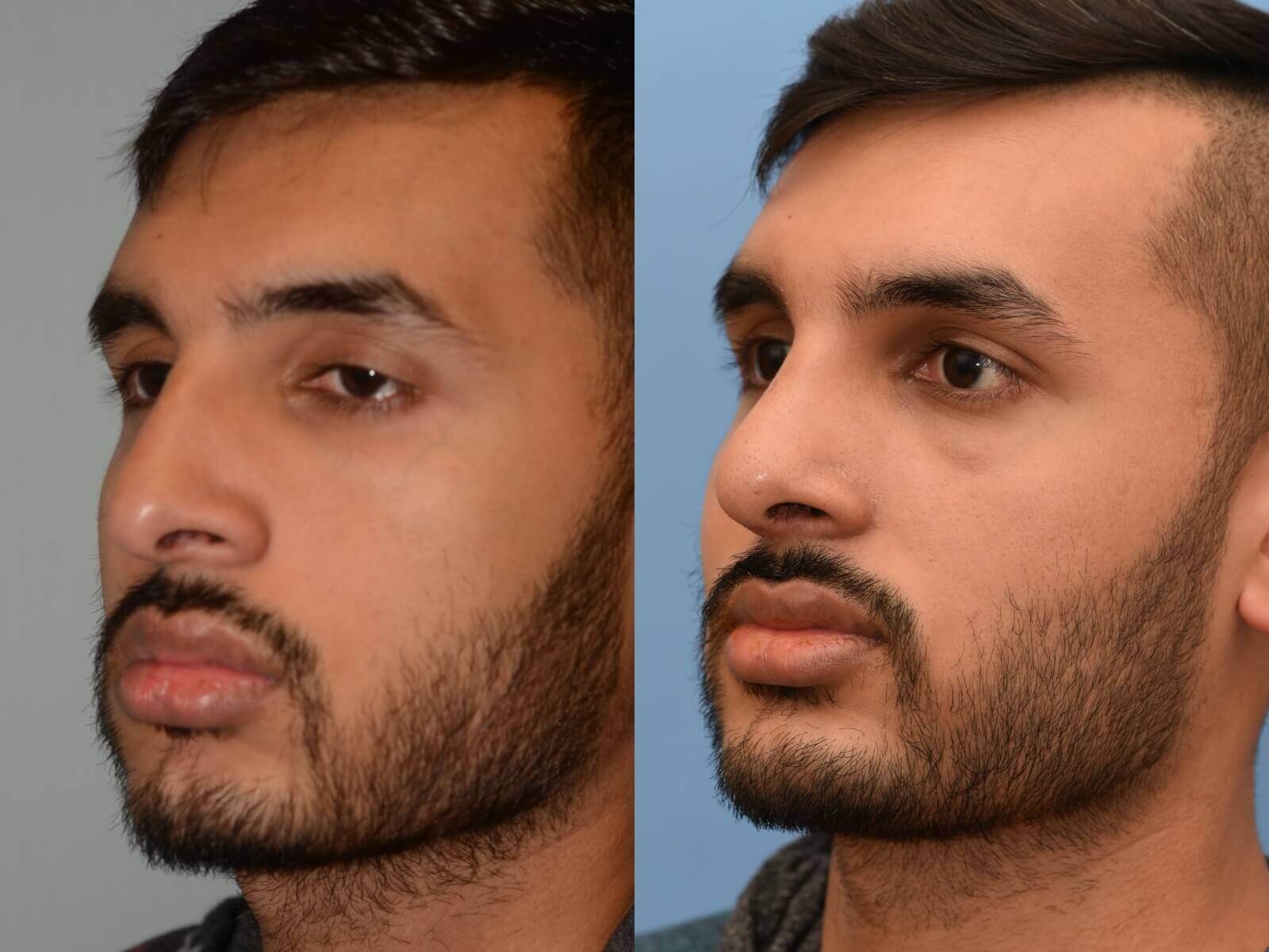 Revision Rhinoplasty Houston, TX - Before & After Photos - Gallery #51761