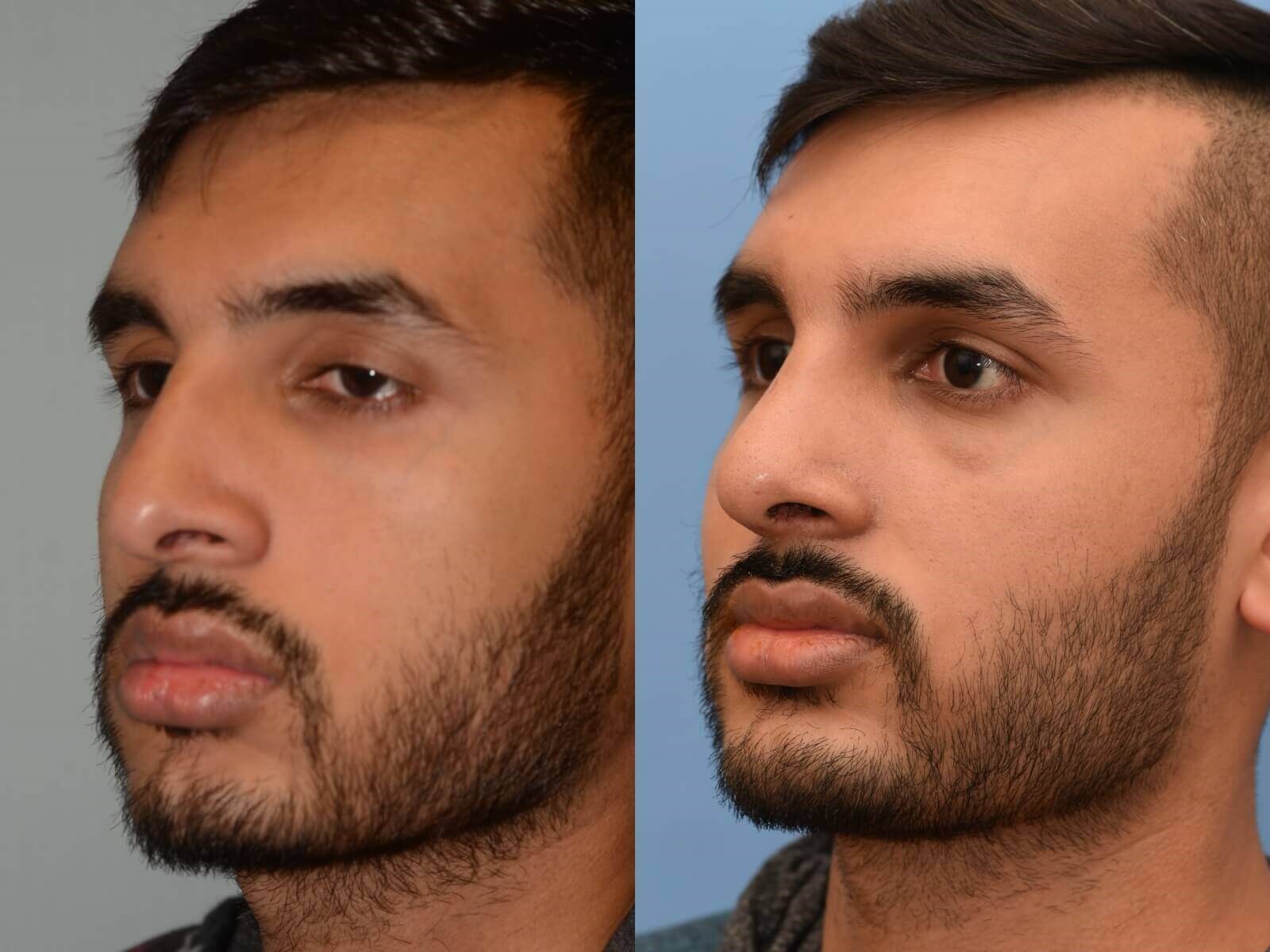 Revision Rhinoplasty Before and After