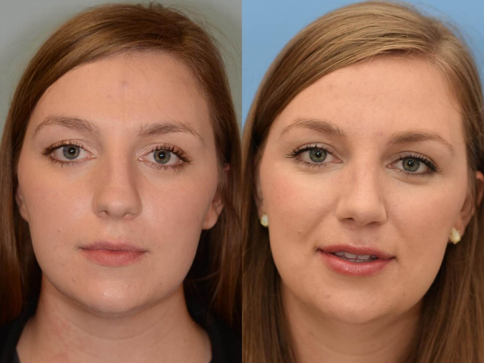 Septorhinoplasty Before and After
