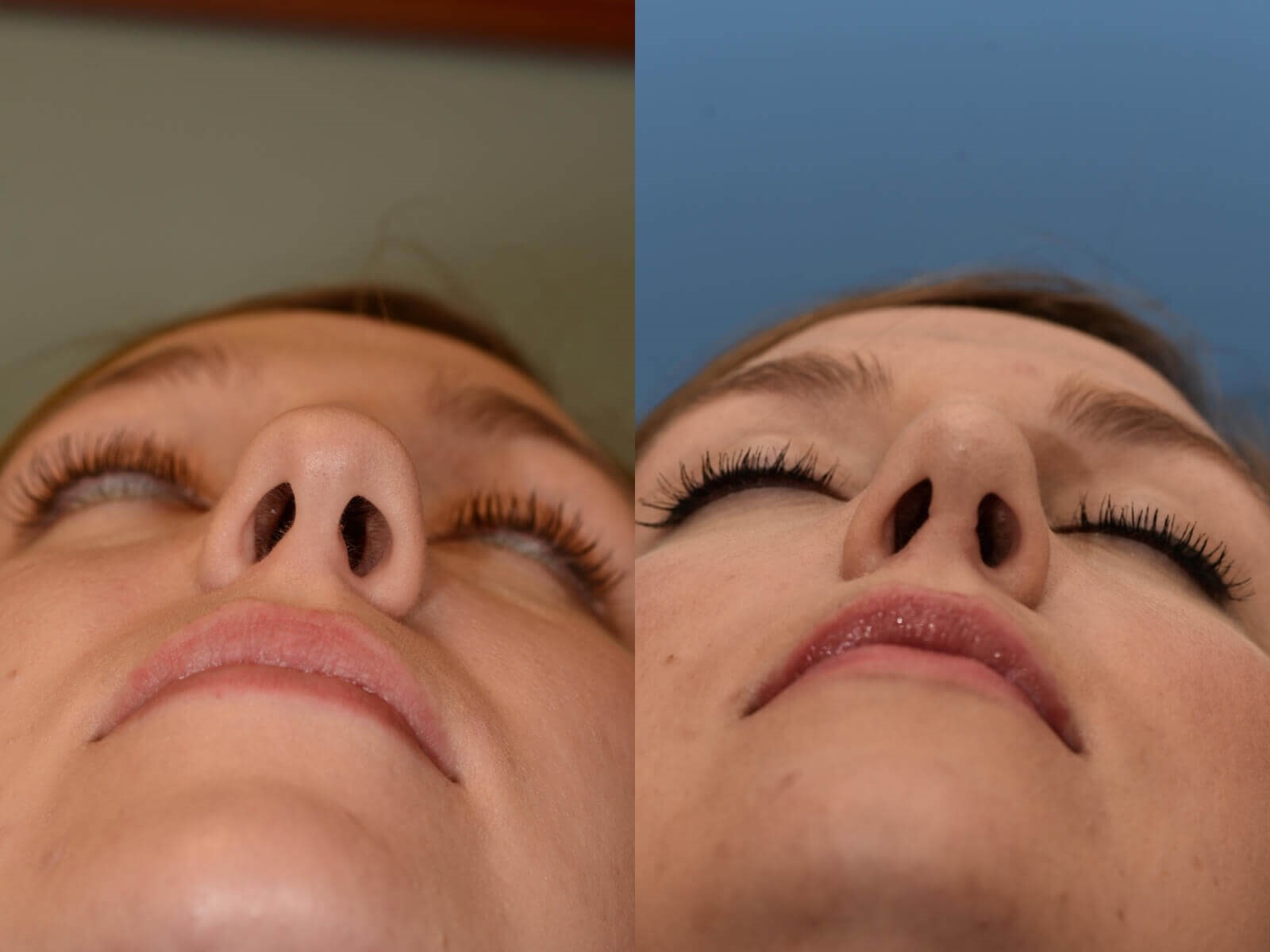 Rhinoplasty Houston Tx Before And After Photos Gallery 51771