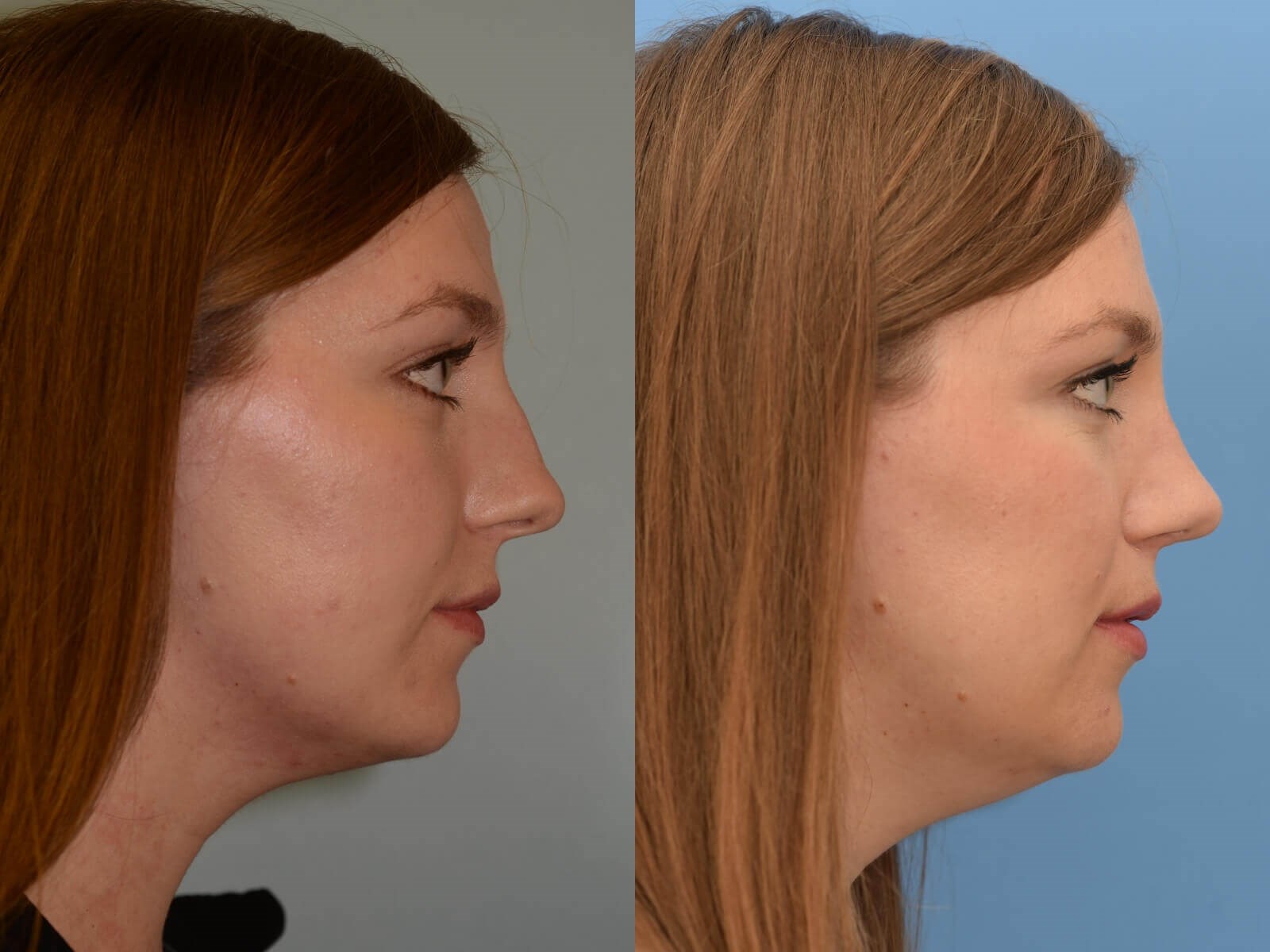 Septorhinoplasty Before and After