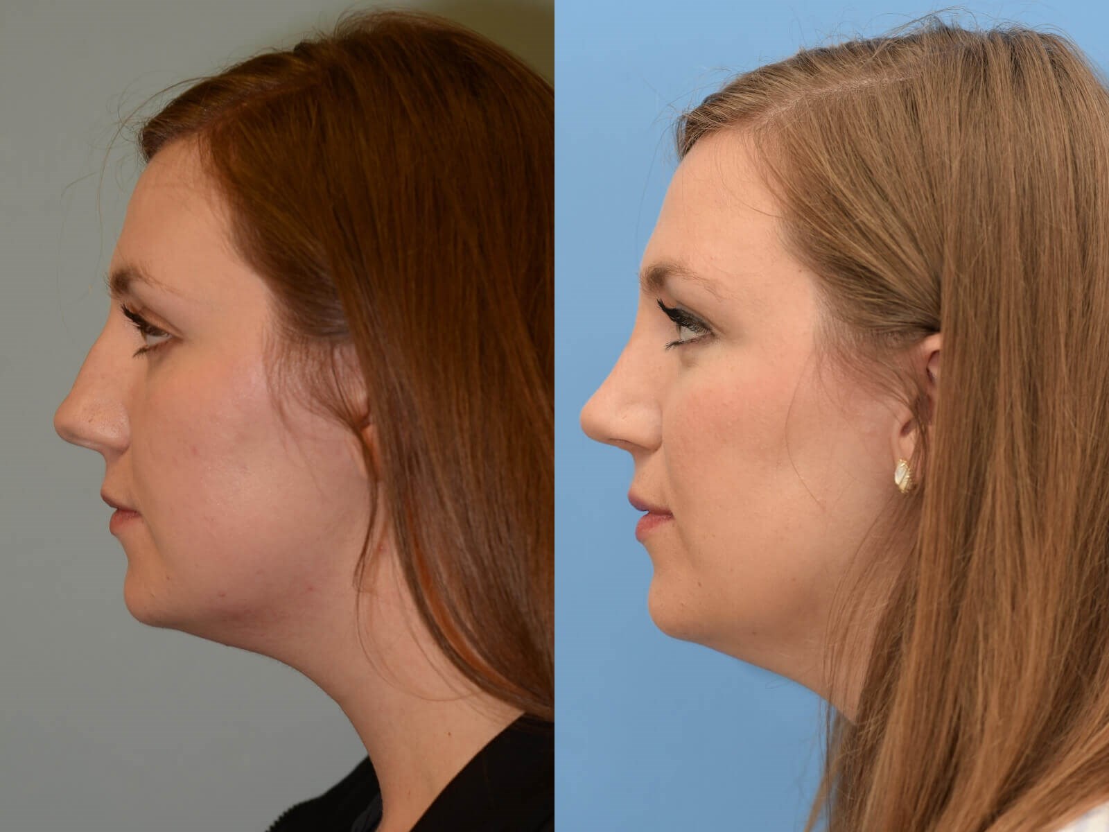 Septorhinoplasty Before and After
