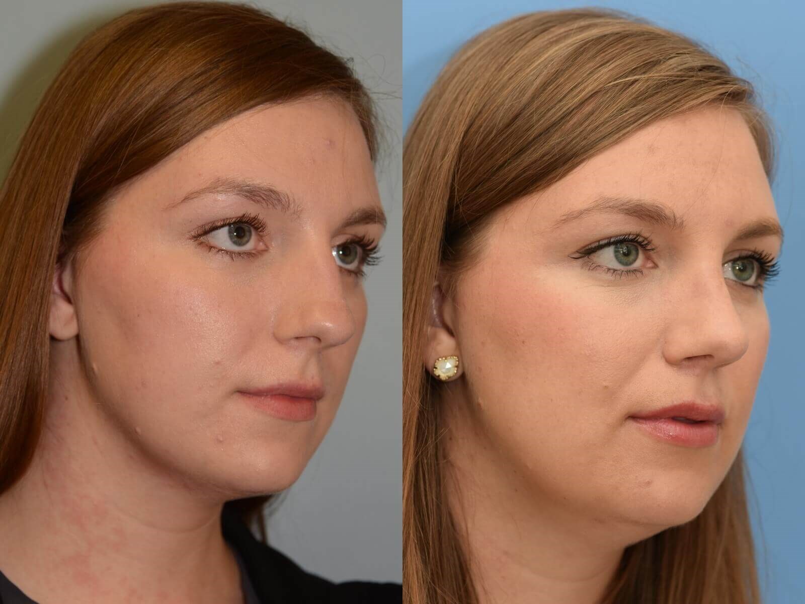 Septorhinoplasty Before and After