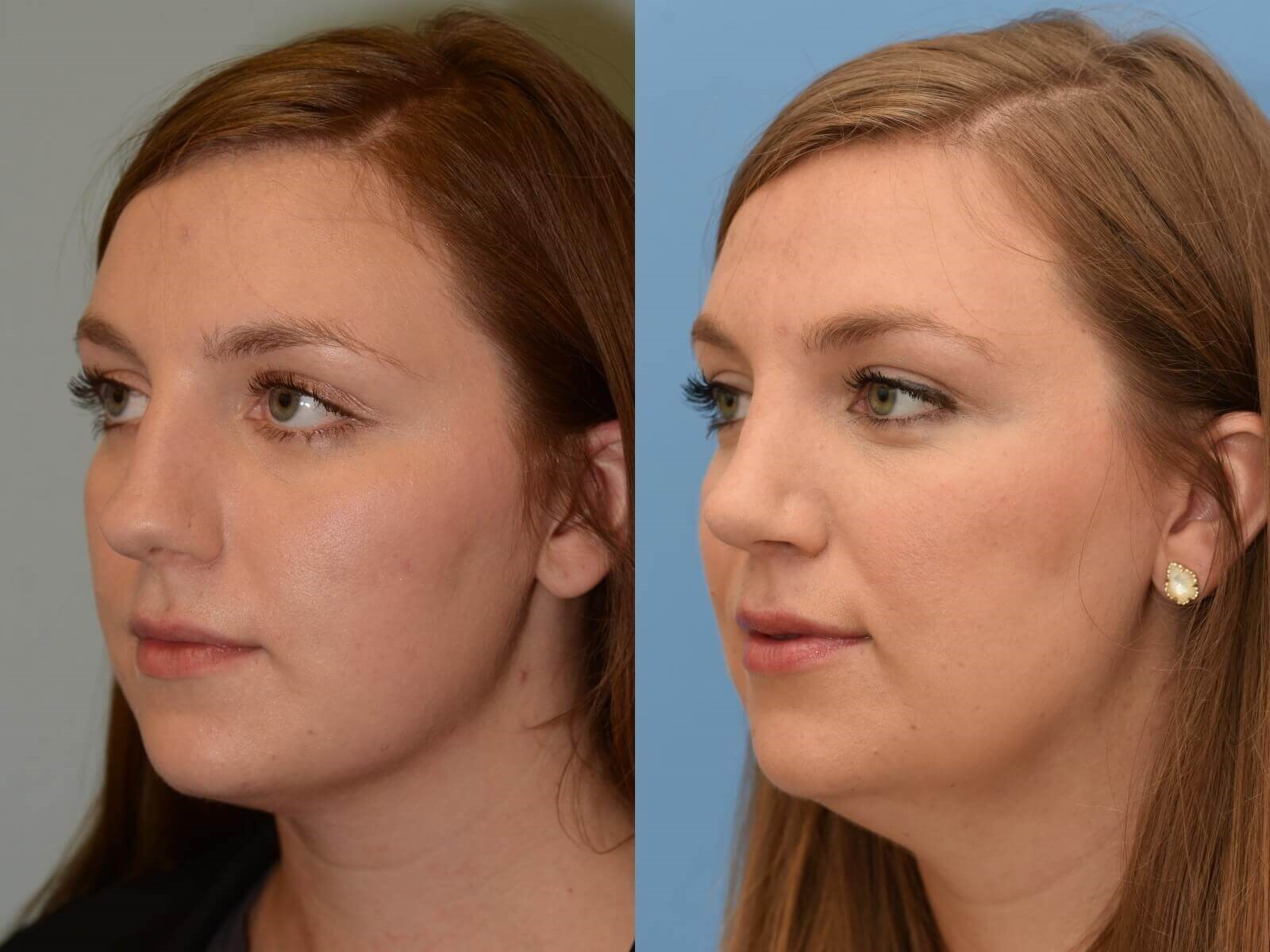 Septorhinoplasty Before and After