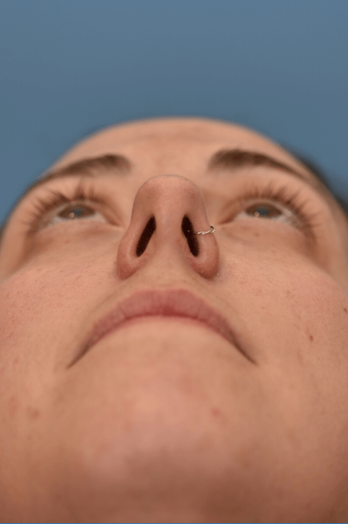 Nasal obstruction before
