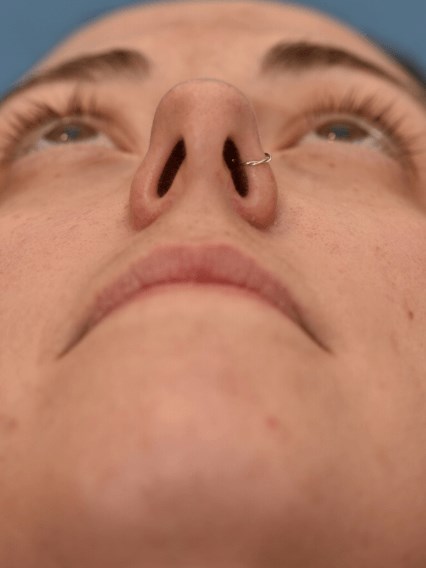 Nasal obstruction before