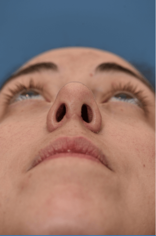 Nasal obstruction After