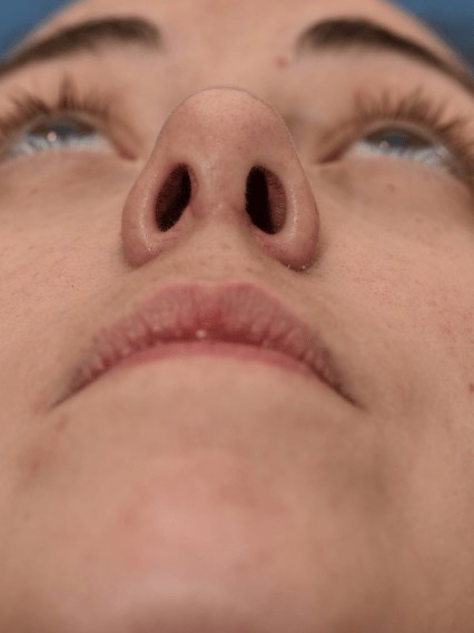 Nasal obstruction After