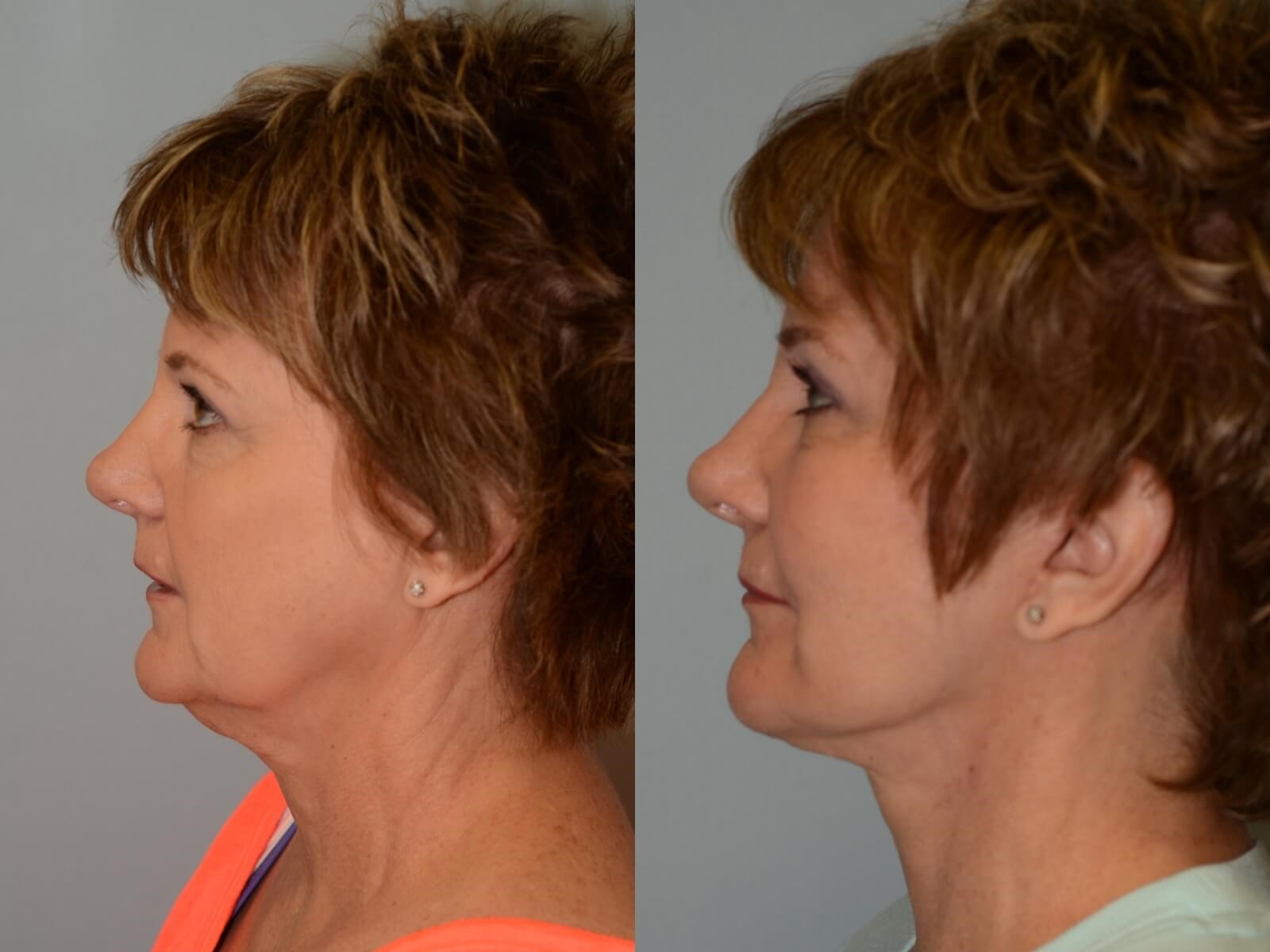 Facelift, Necklift Profile After