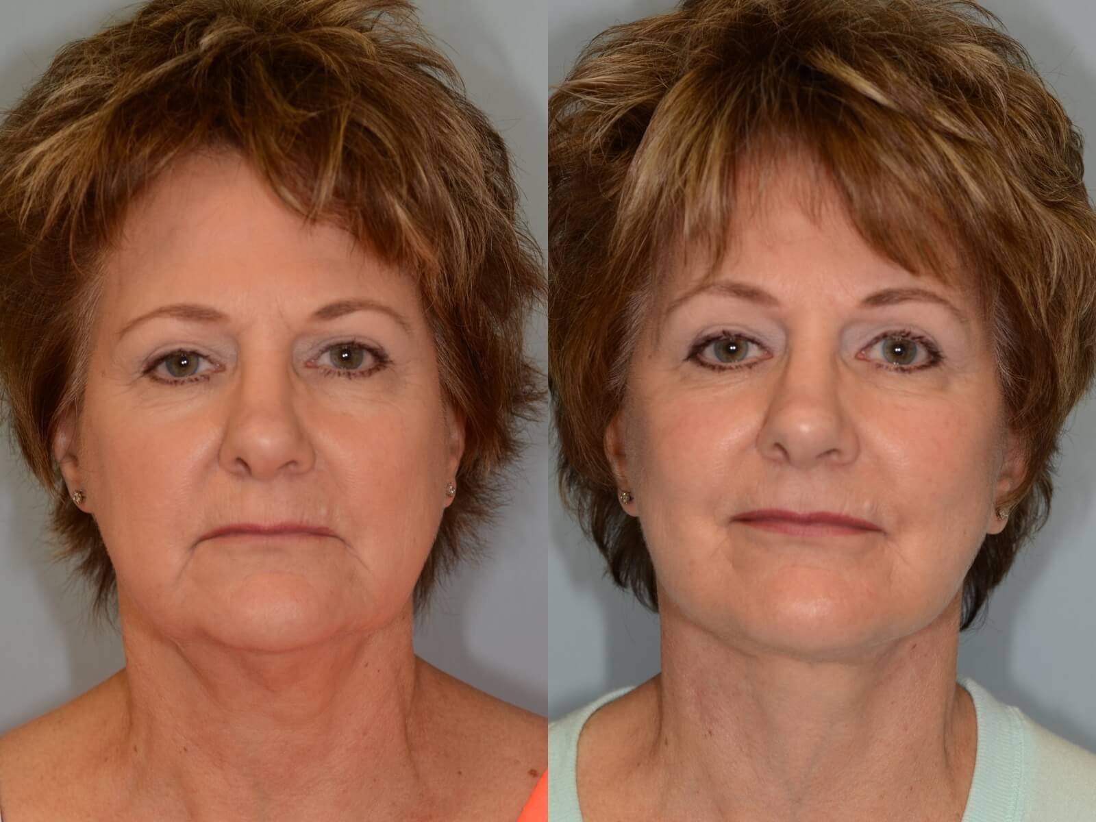 Facelift and Necklift Houston Before