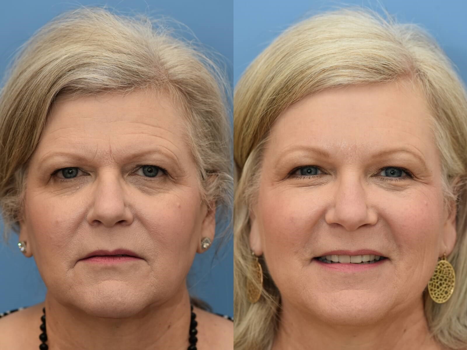 Fat transfer, Browlift Houston Before