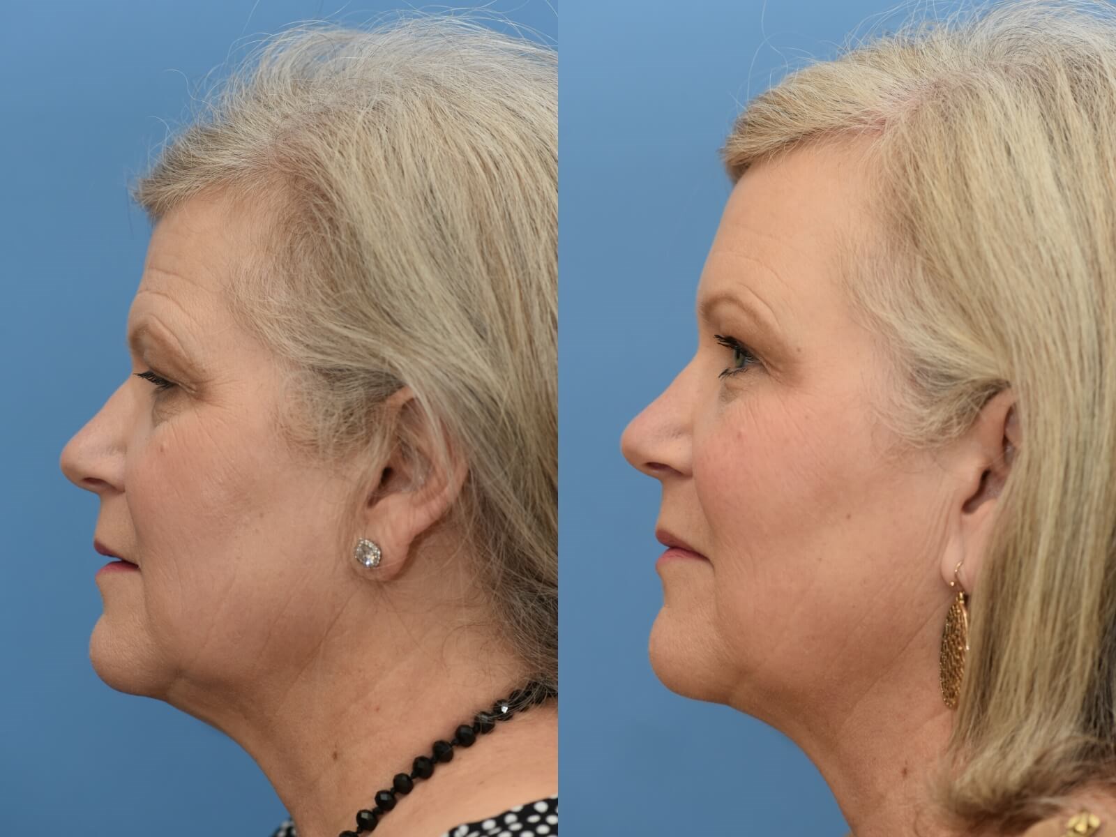Browlift, ALMI Fat Transfer After