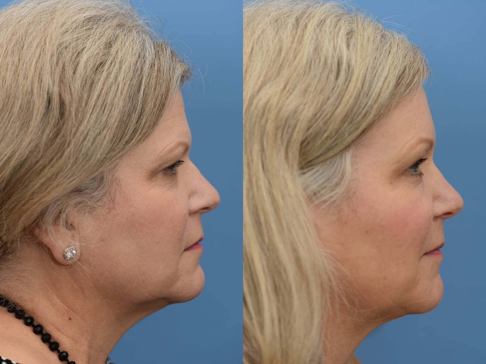 Browlift, ALMI Fat Transfer Before